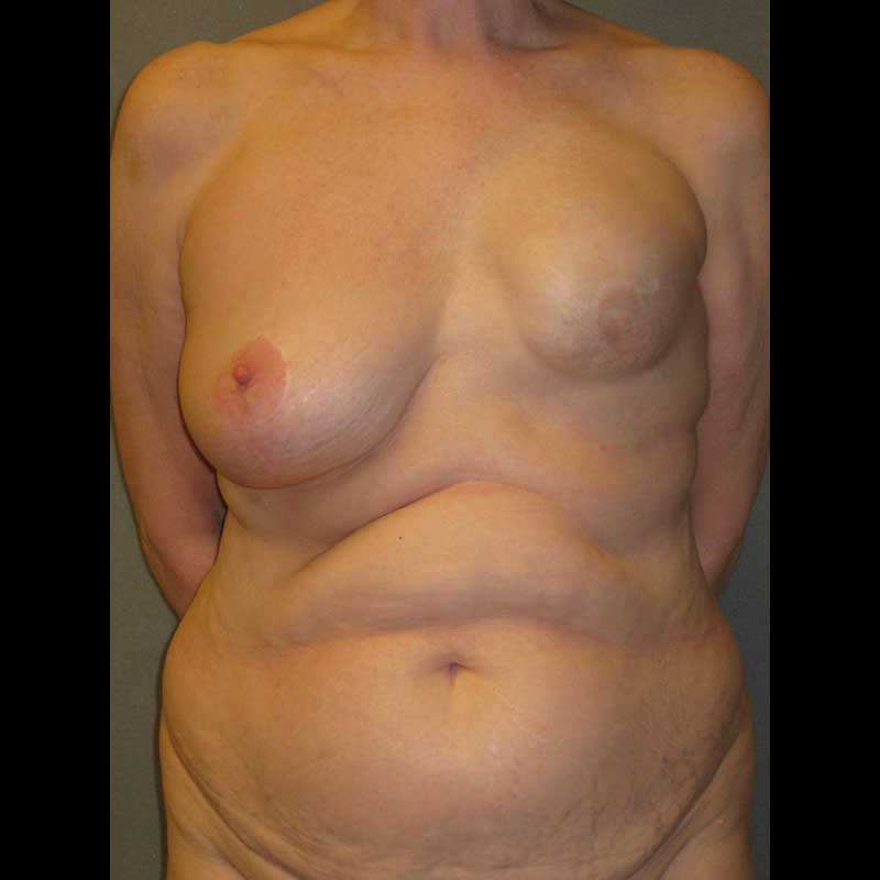 Breast Reconstruction Diep Flap before and after - before