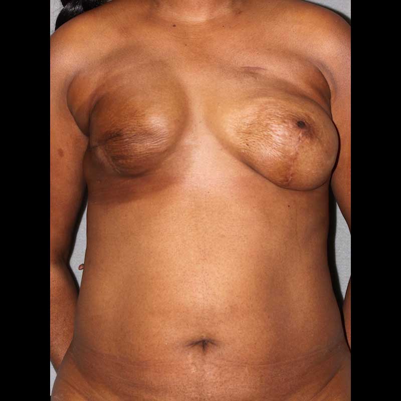 Breast Reconstruction Diep Flap before and after - before
