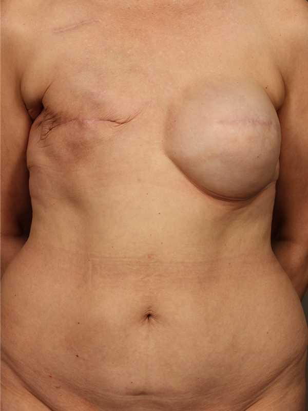 Breast Reconstruction Diep Flap before and after - before