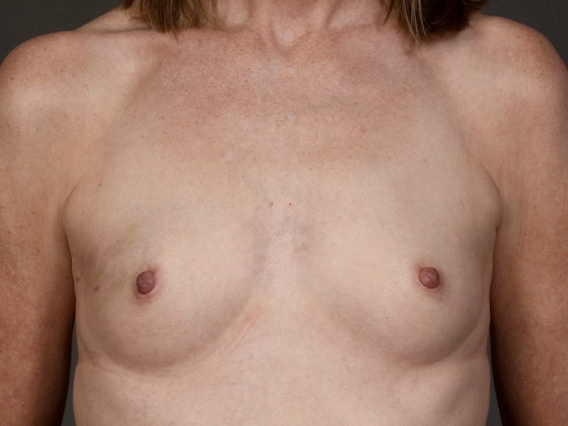 Breast Reconstruction Expander Implant: Nipple Sparing Mastectomy before and after - before