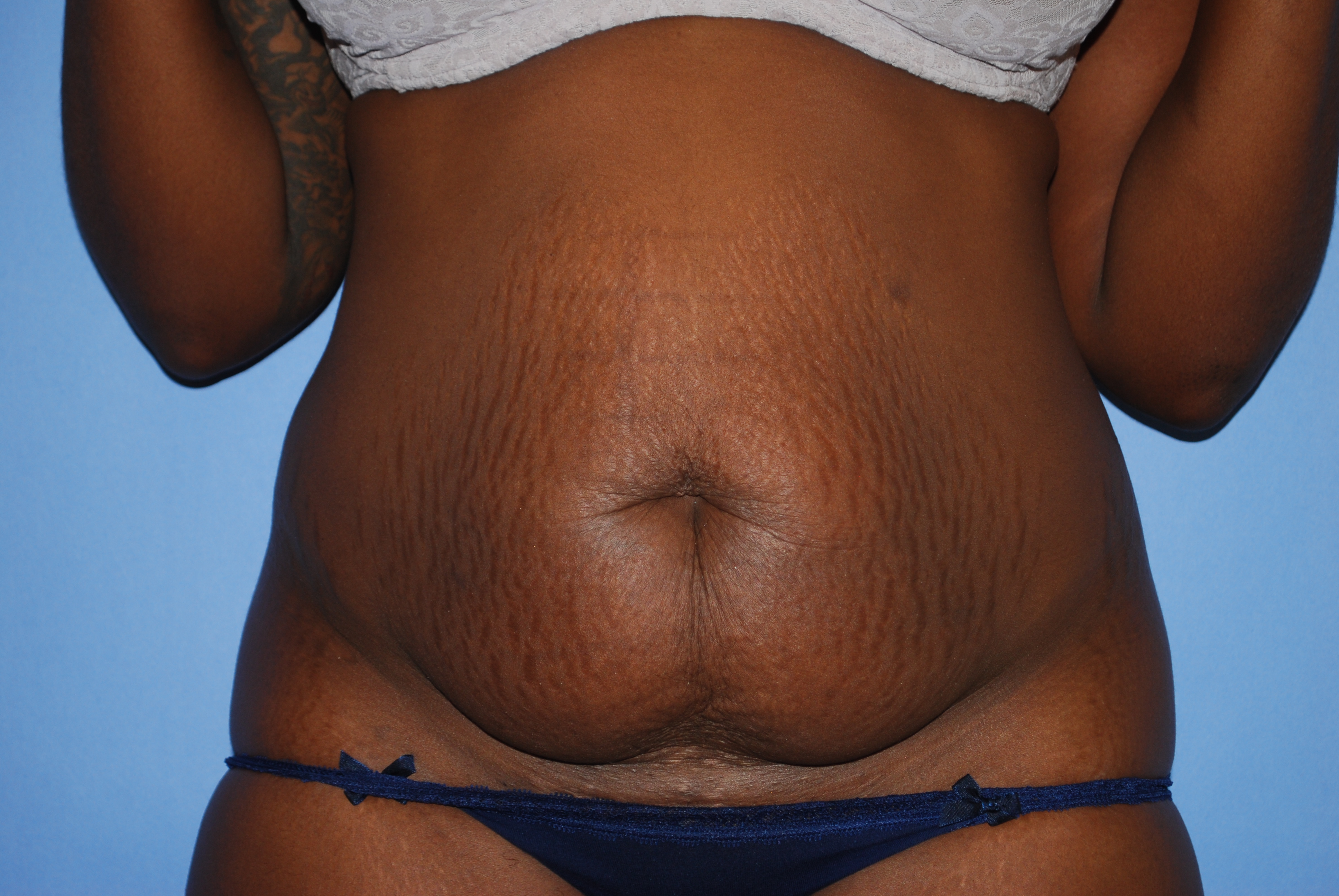 Abdominoplasty (Tummy Tuck) before and after - before