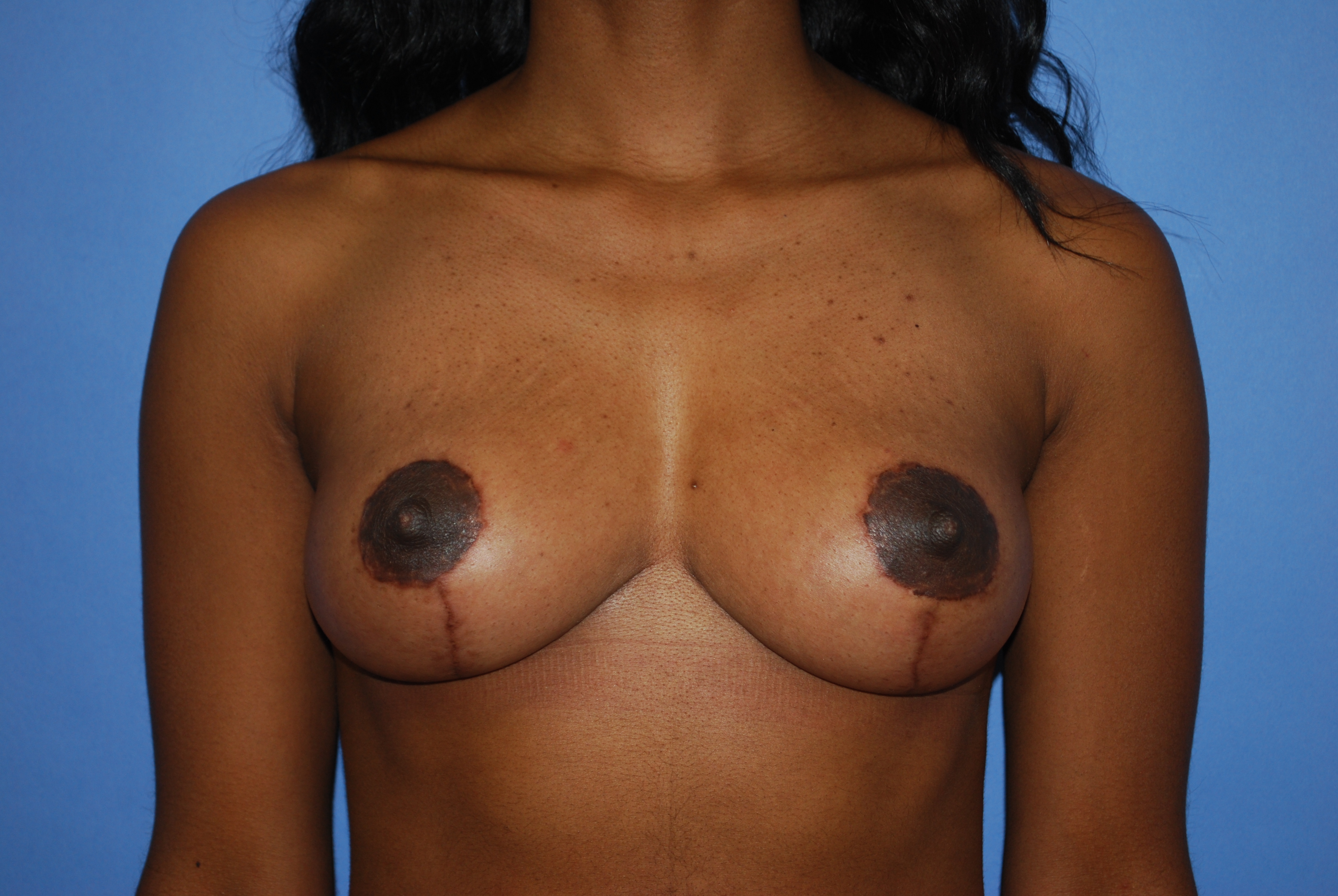 Breast Mastopexy (Lift) before and after - after