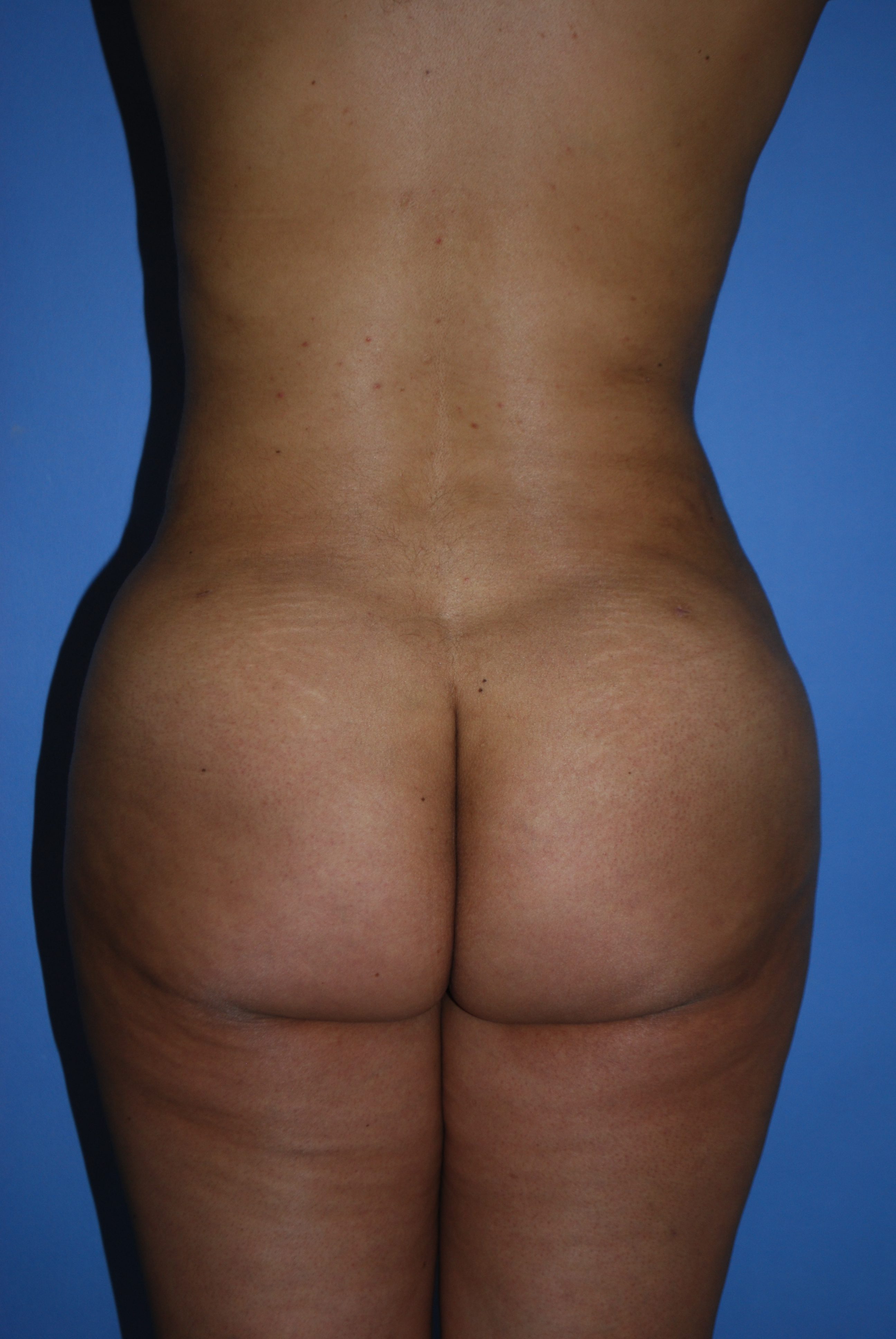 BBL (Fat Transfer) before and after - after