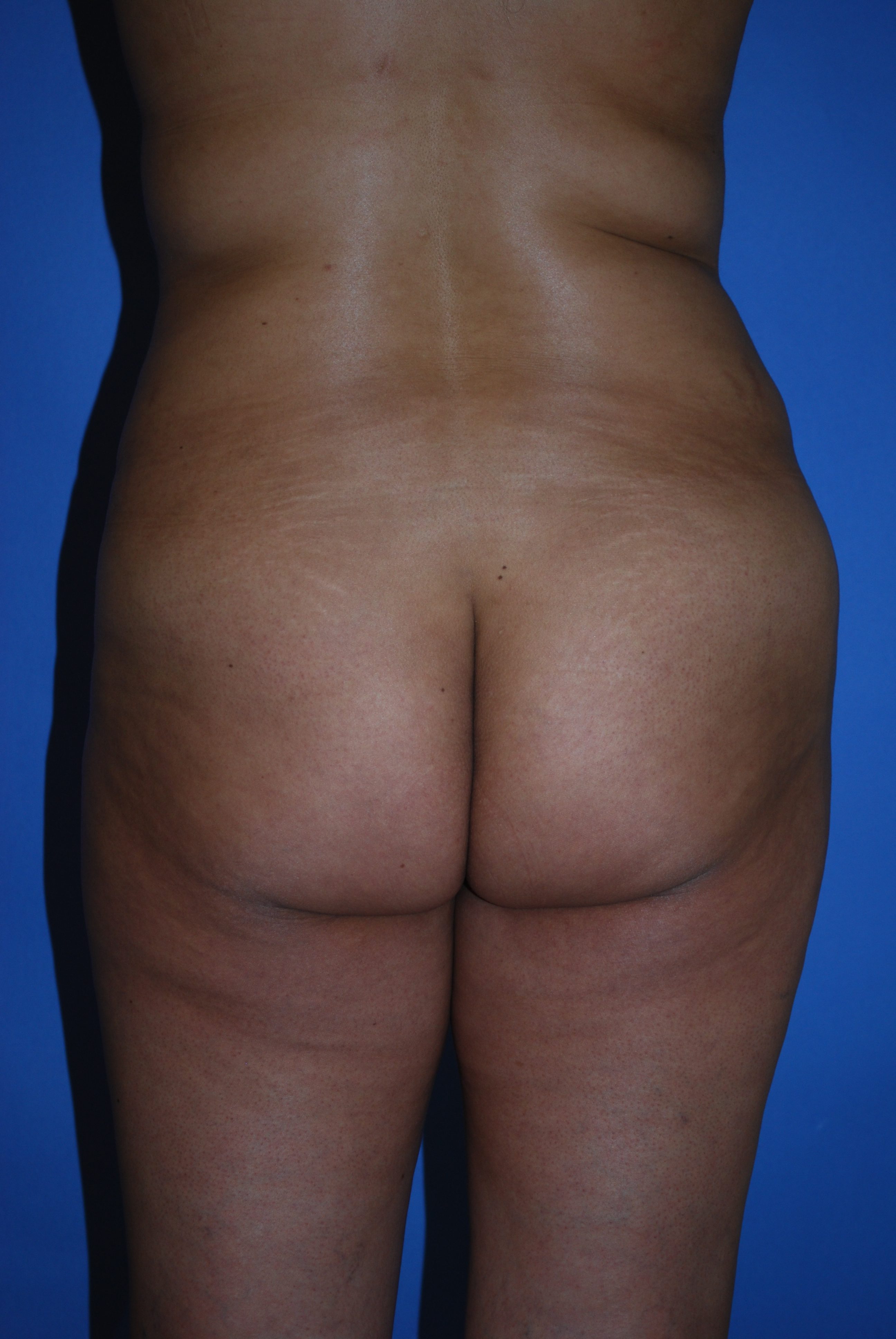 BBL (Fat Transfer) before and after - before