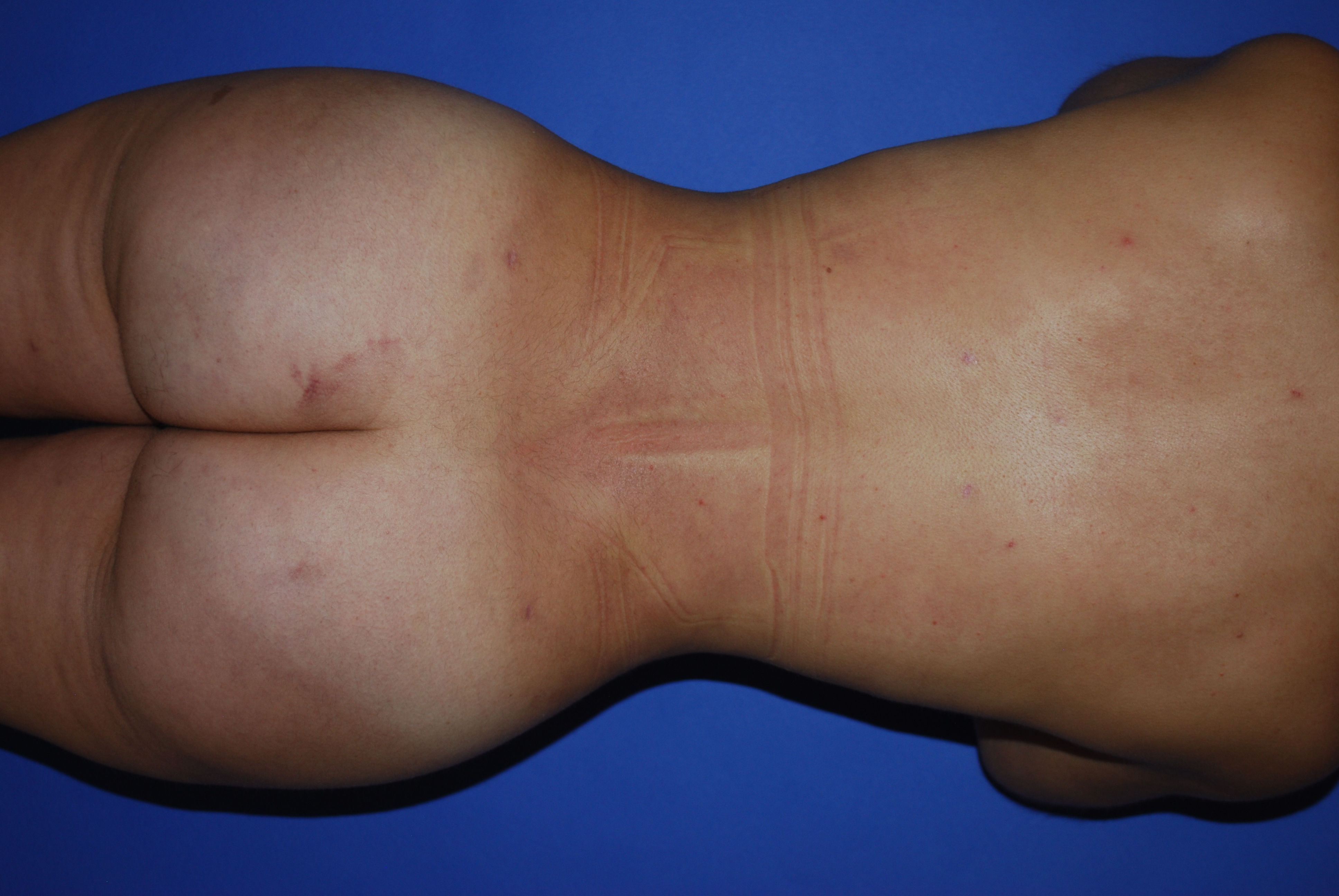 BBL (Fat Transfer) before and after - after