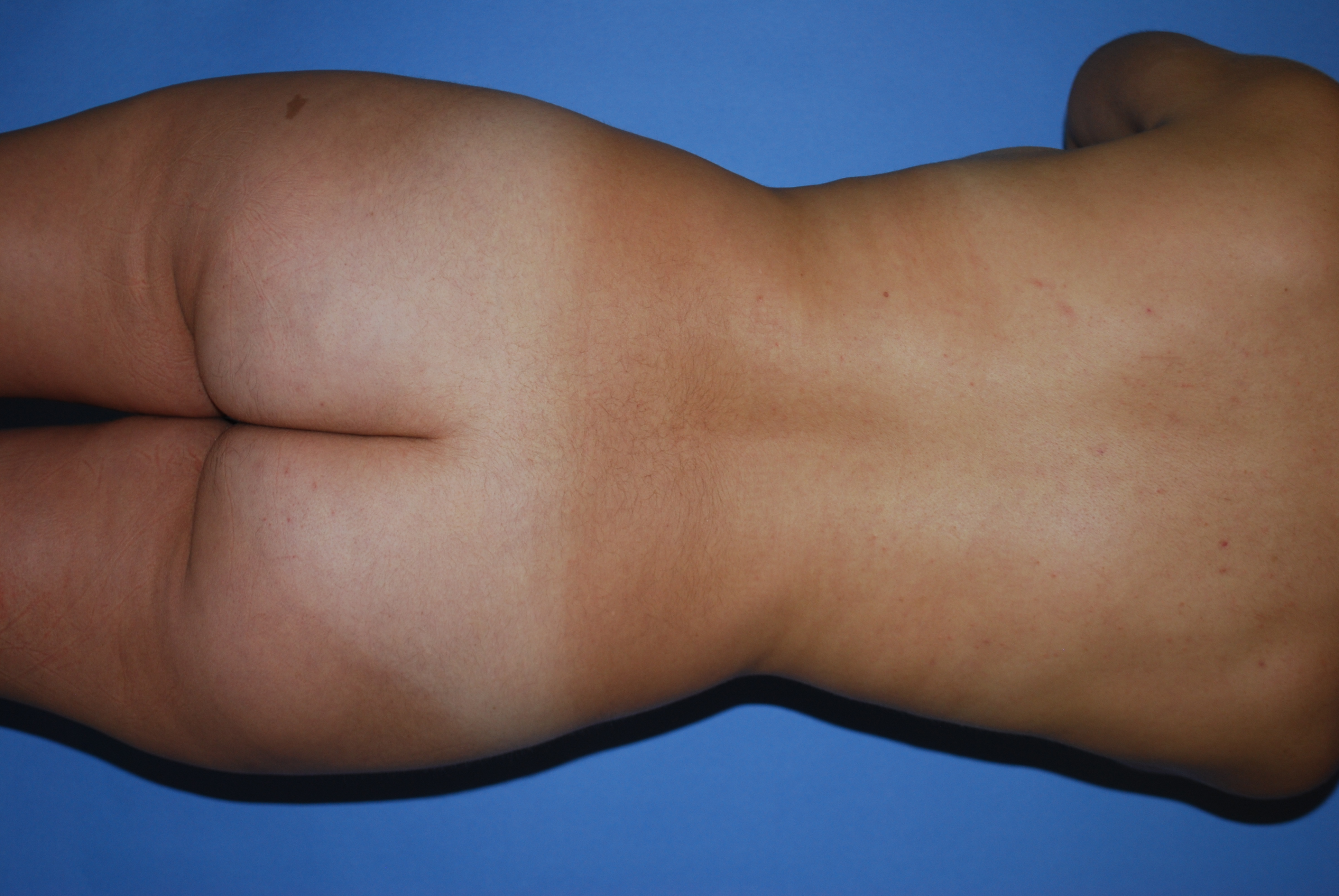 BBL (Fat Transfer) before and after - before