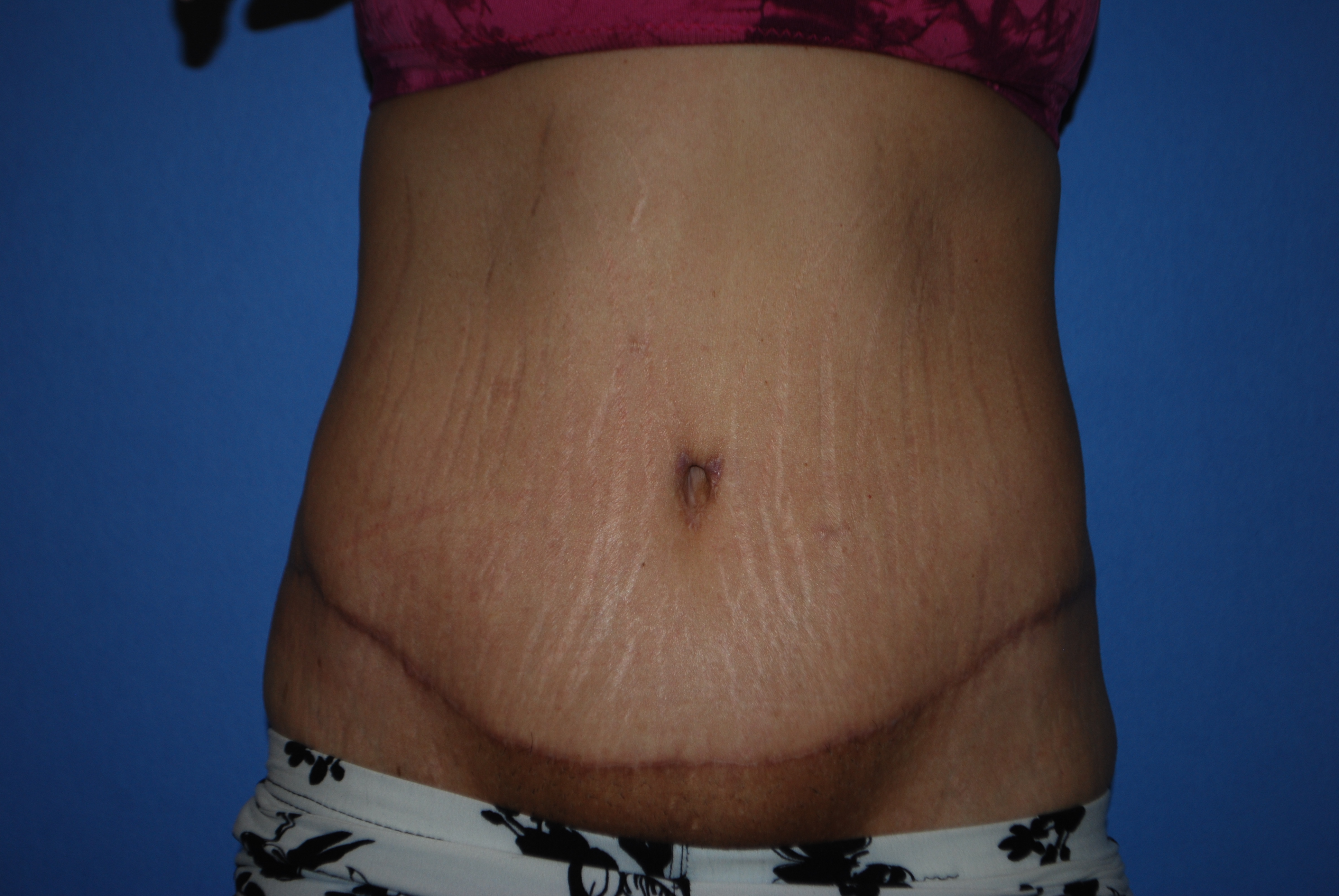 Abdominoplasty (Tummy Tuck) before and after - after