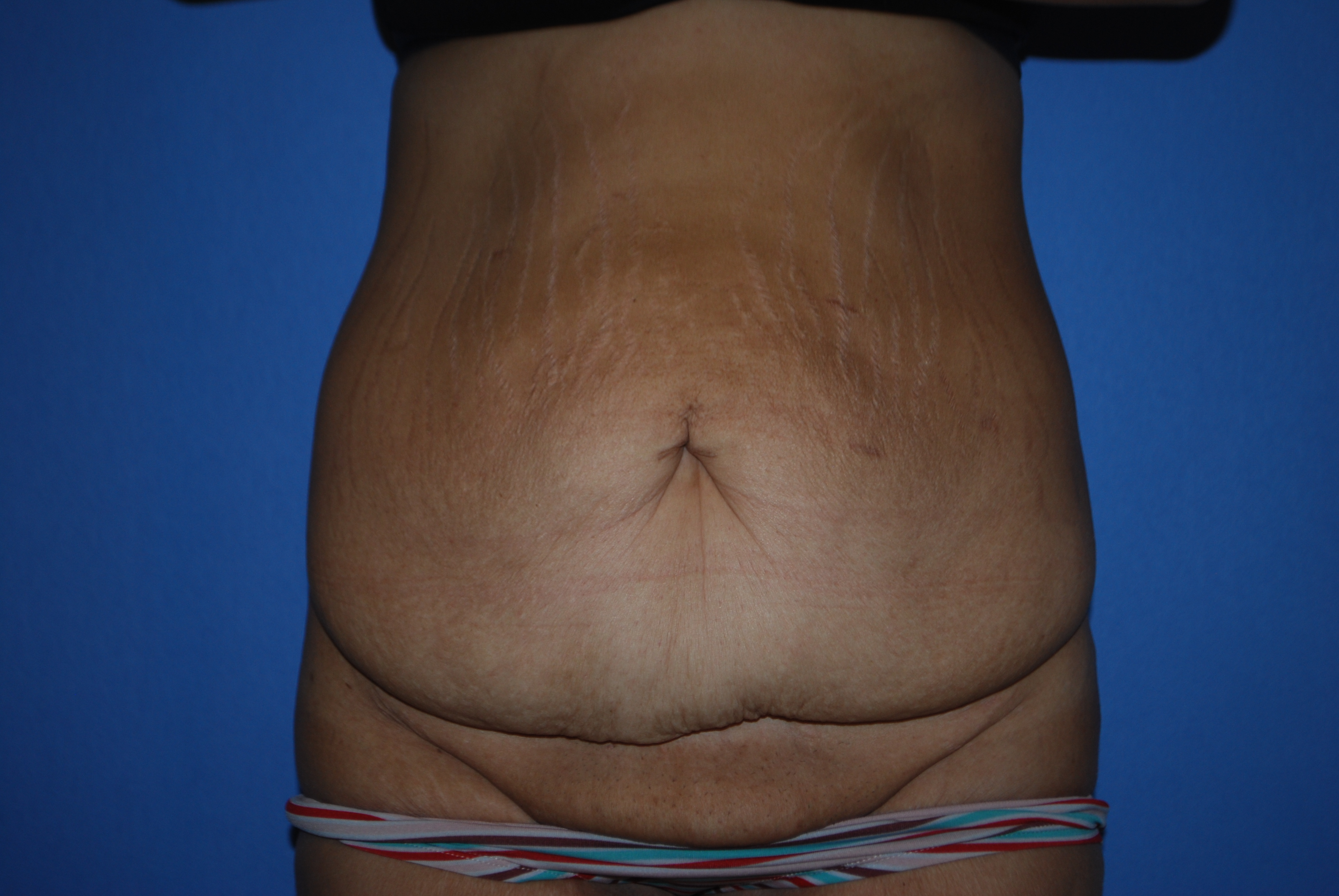 Abdominoplasty (Tummy Tuck) before and after - before