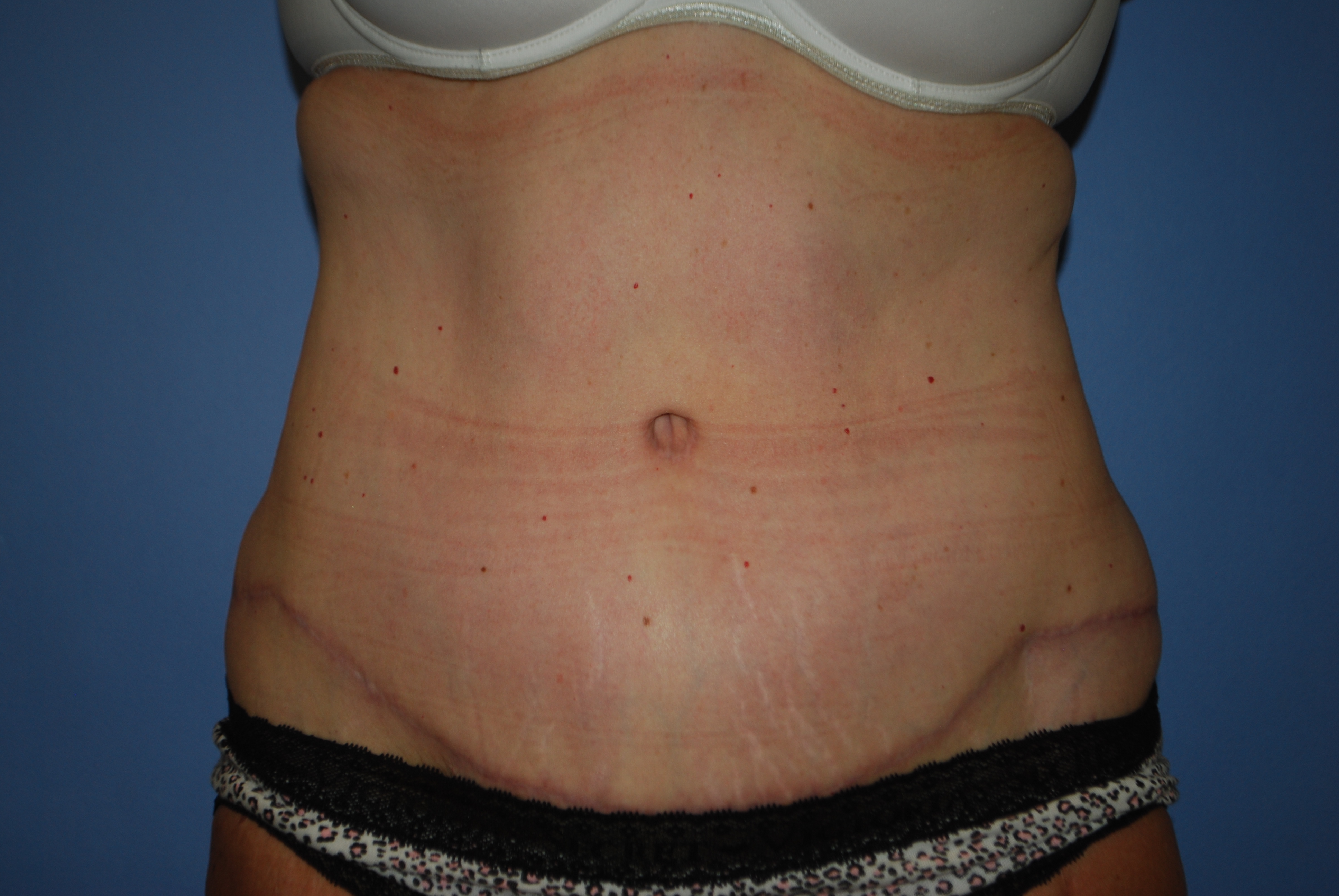 Abdominoplasty (Tummy Tuck) before and after - after