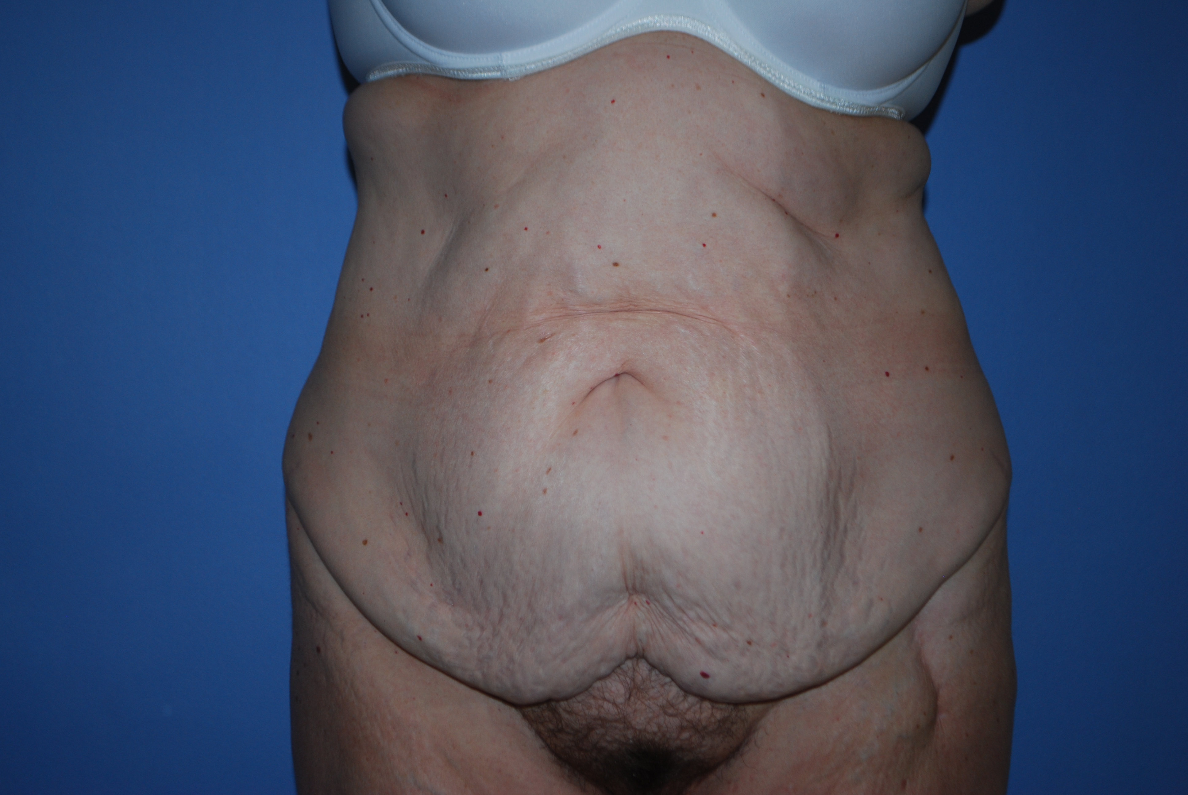Abdominoplasty (Tummy Tuck) before and after - before