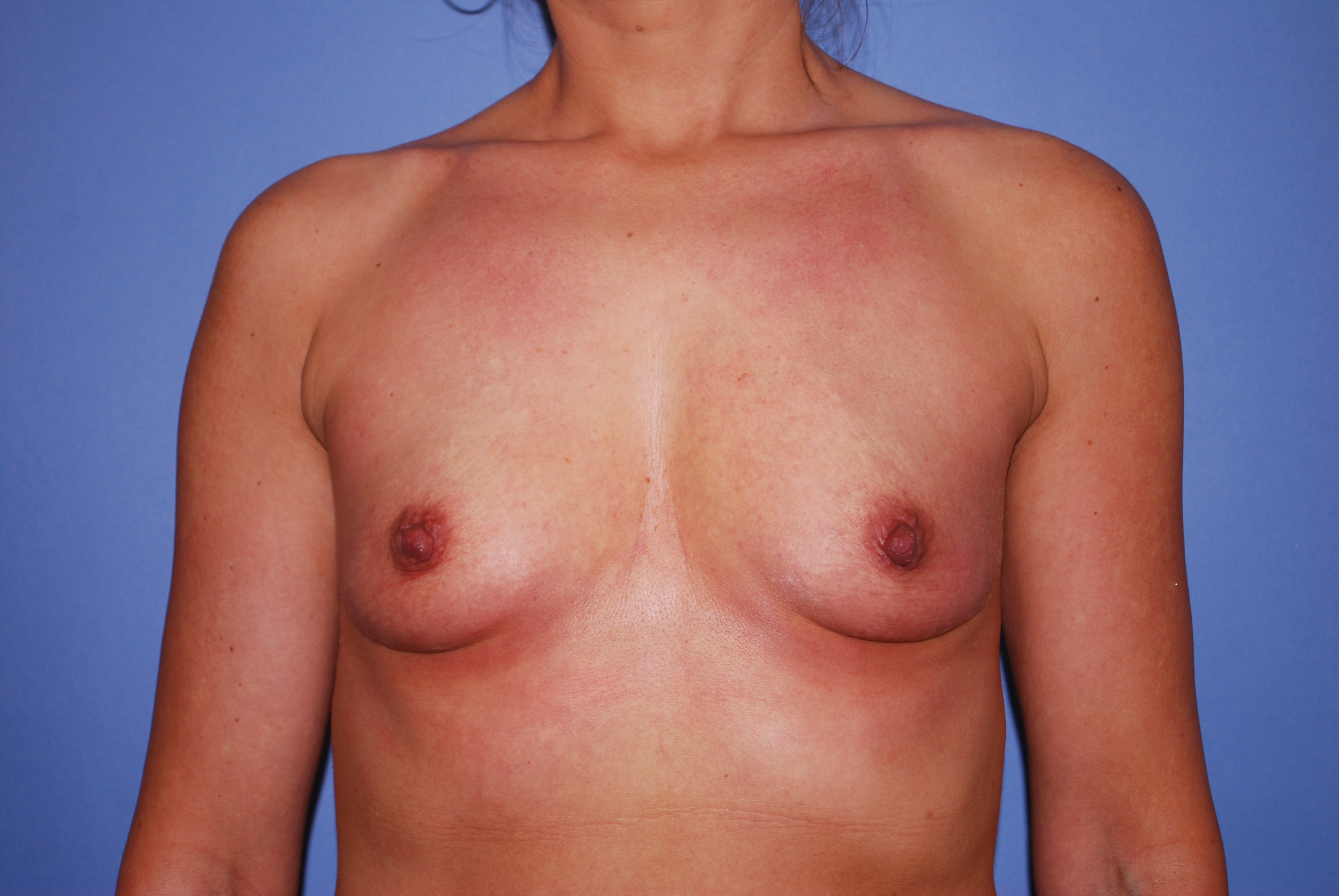 Breast Augmentation before and after - before