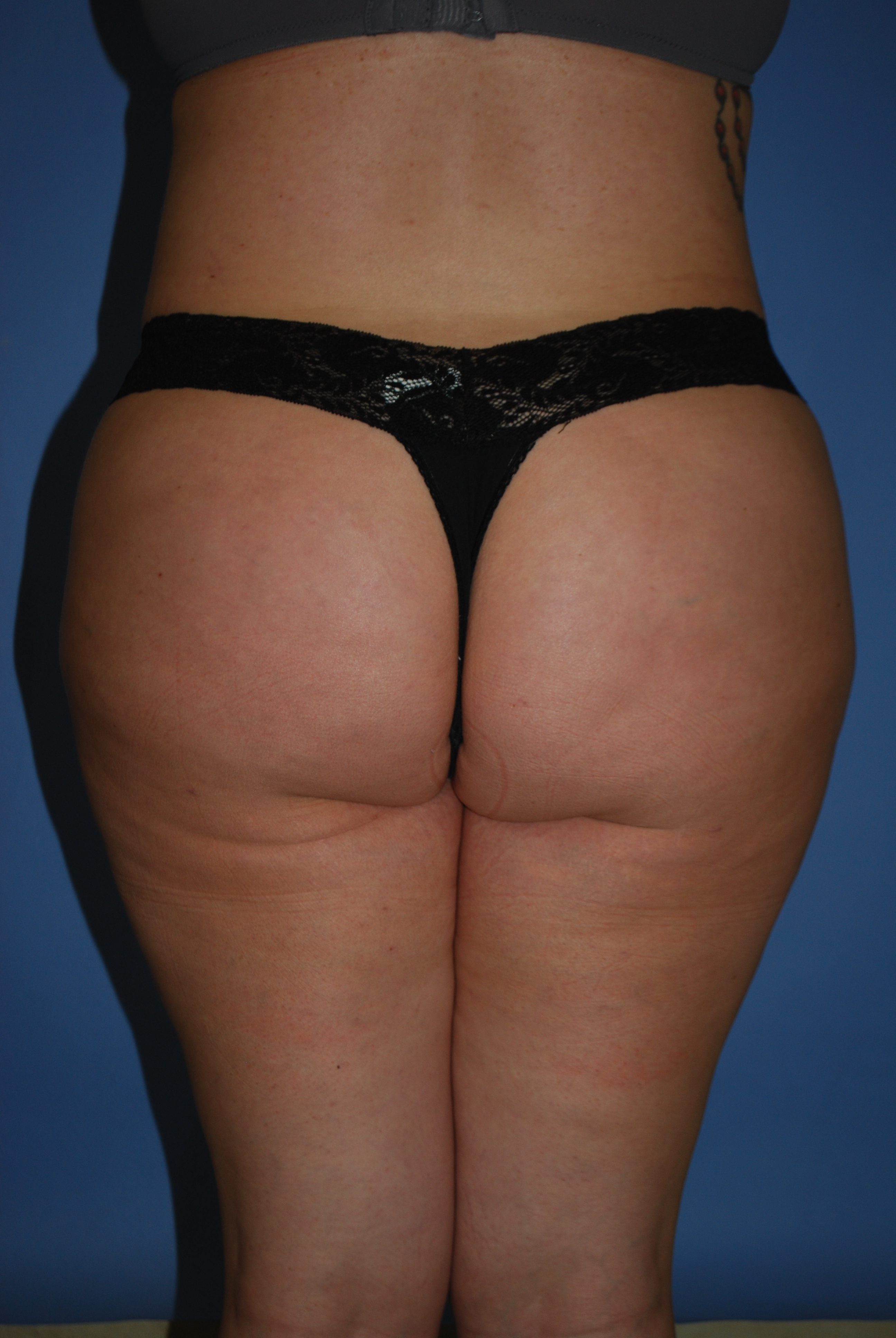 BBL (Fat Transfer) before and after - after