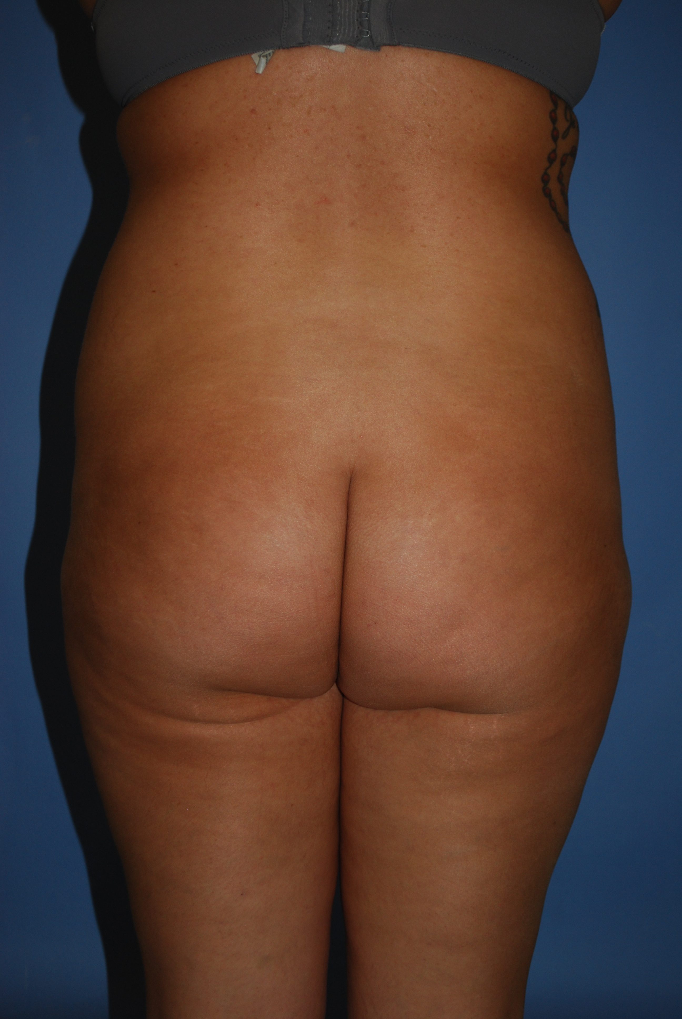 BBL (Fat Transfer) before and after - before