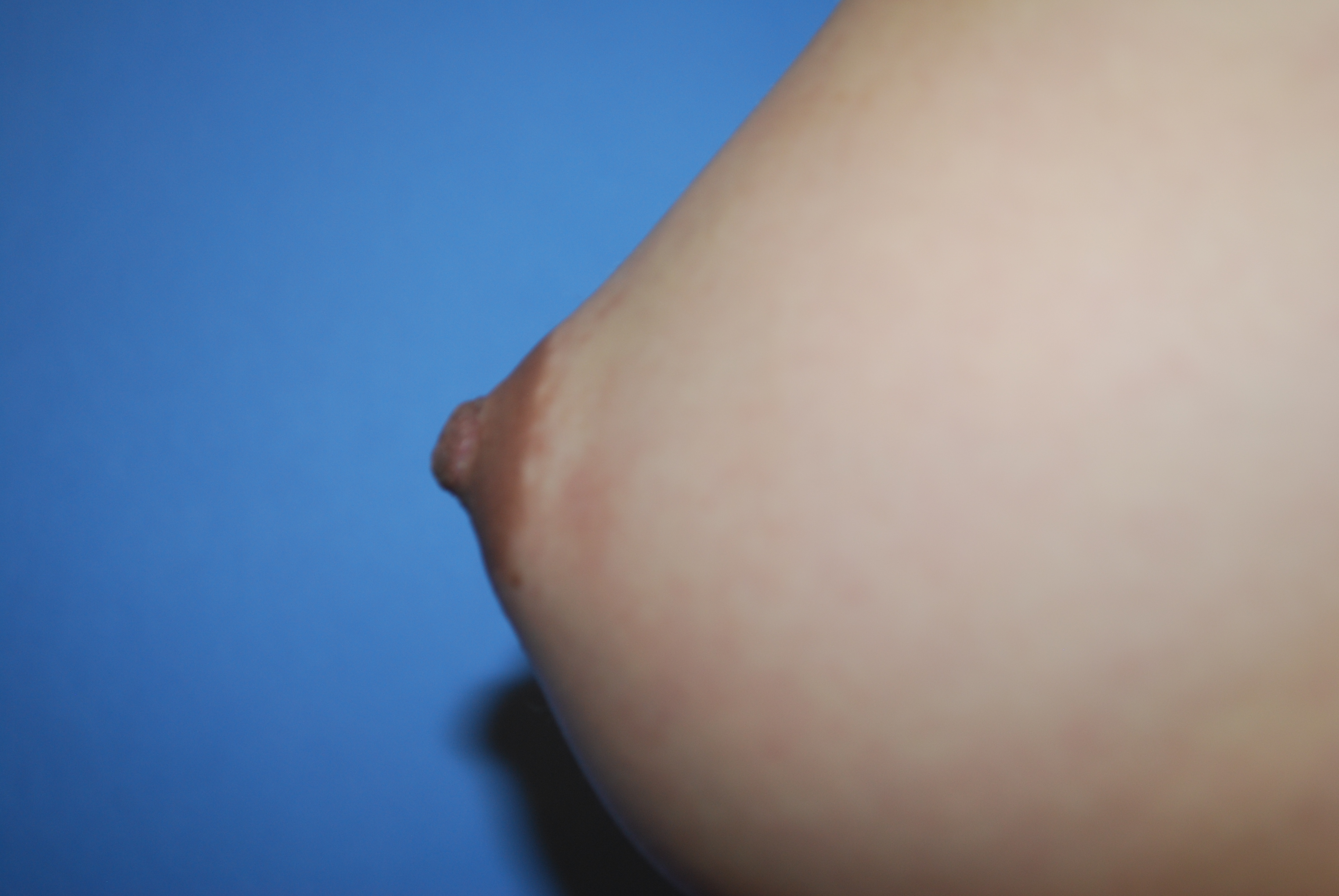 Nipple Reduction before and after - after