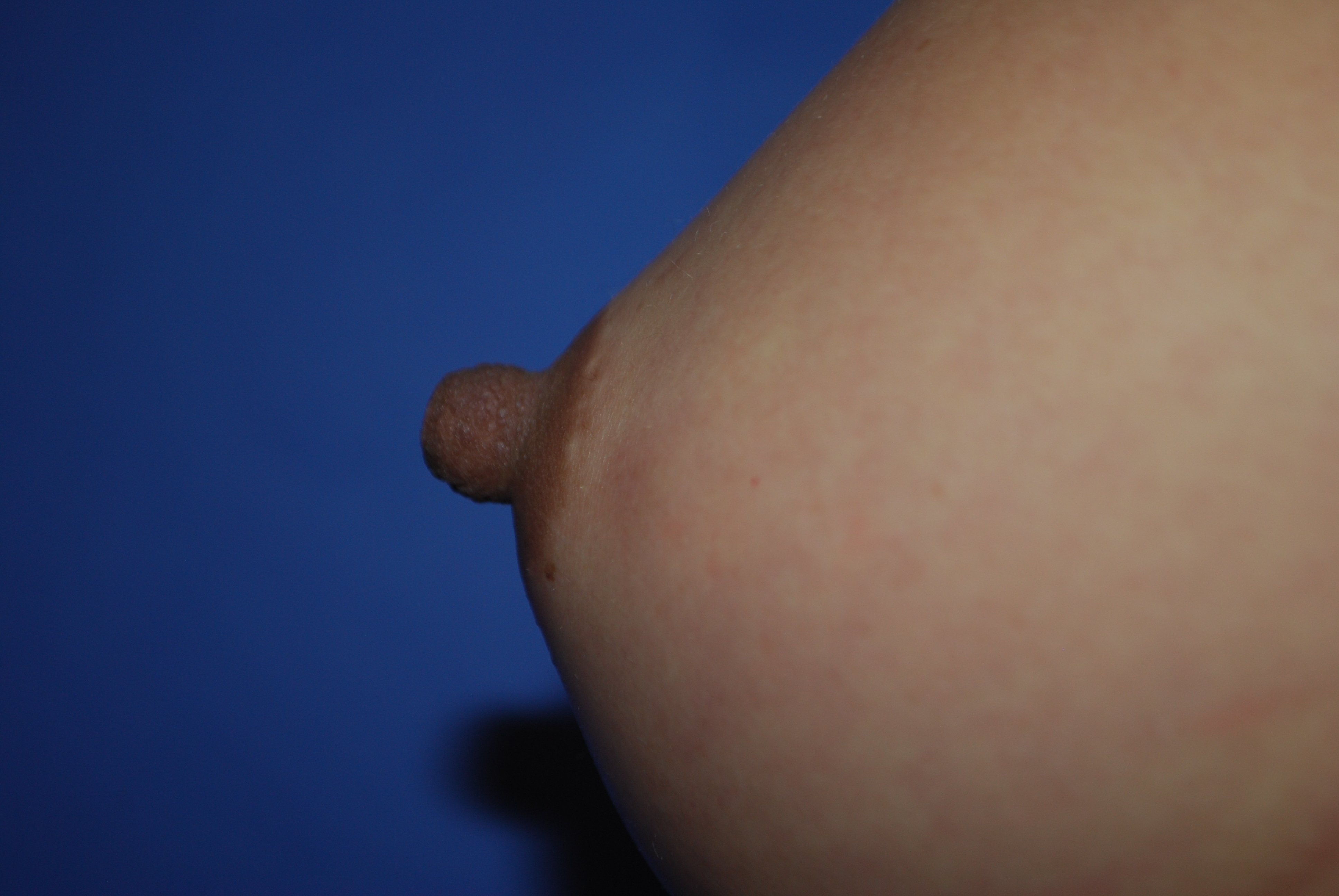 Nipple Reduction before and after - before