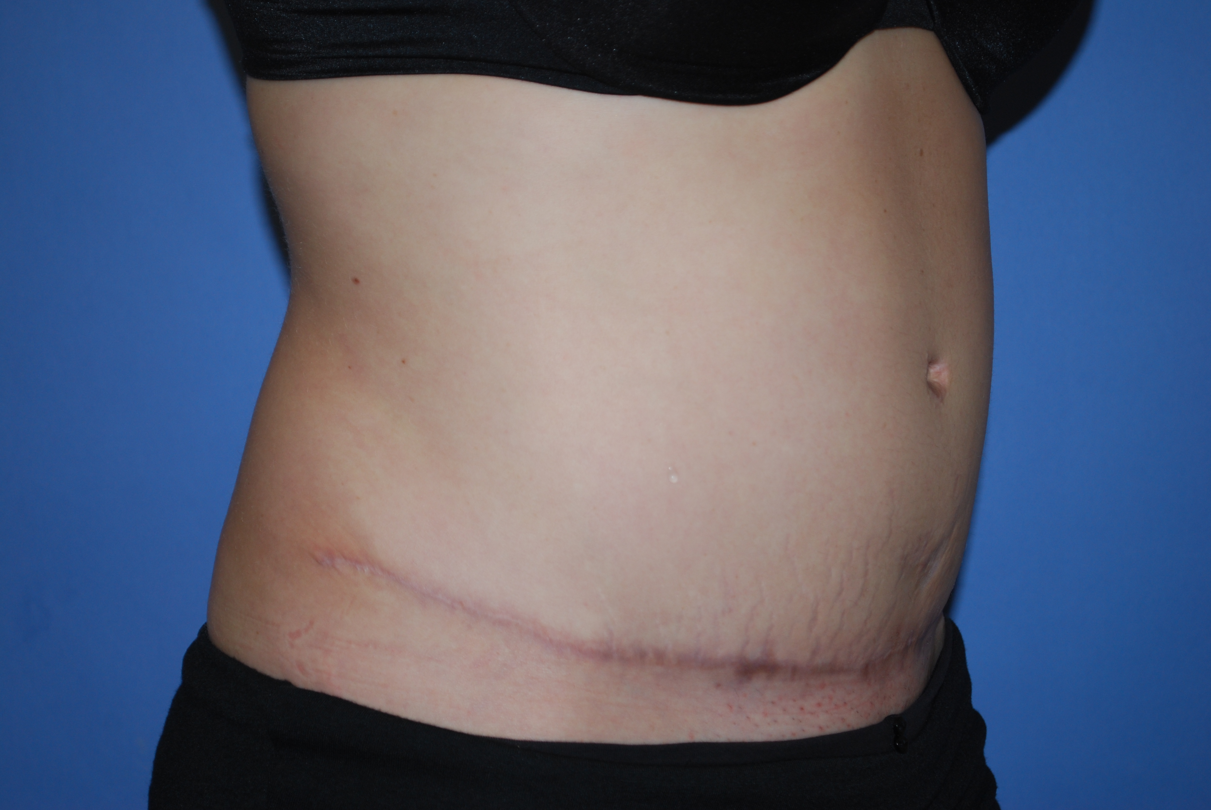 Abdominoplasty (Tummy Tuck) before and after - after