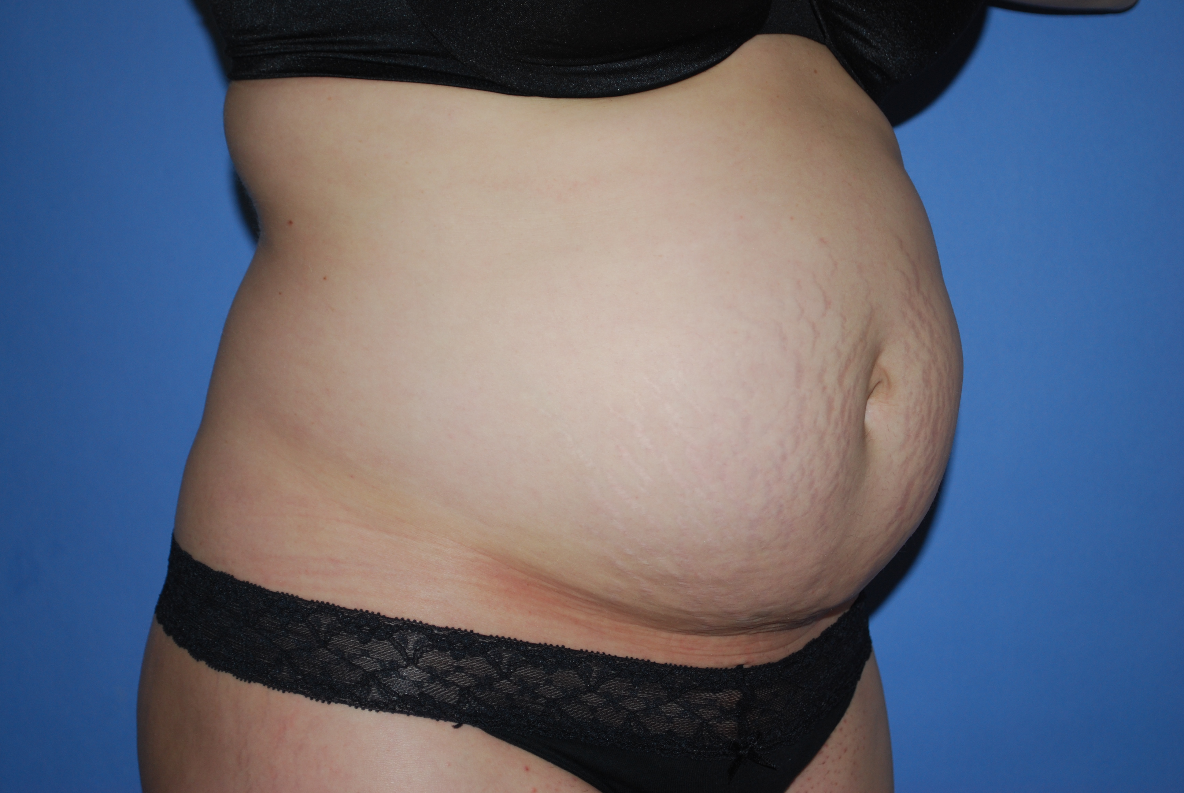 Abdominoplasty (Tummy Tuck) before and after - before