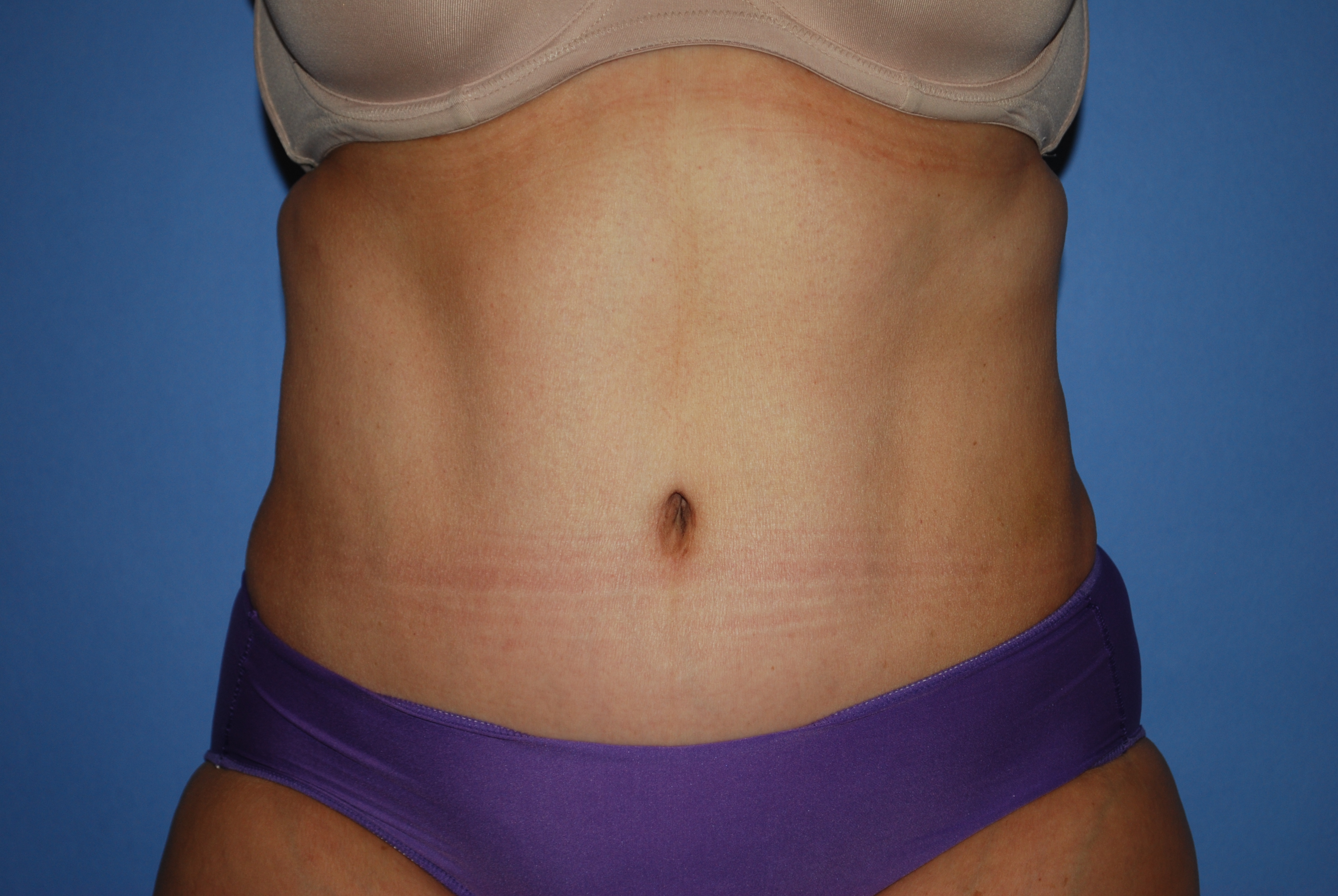 Abdominoplasty (Tummy Tuck) before and after - after