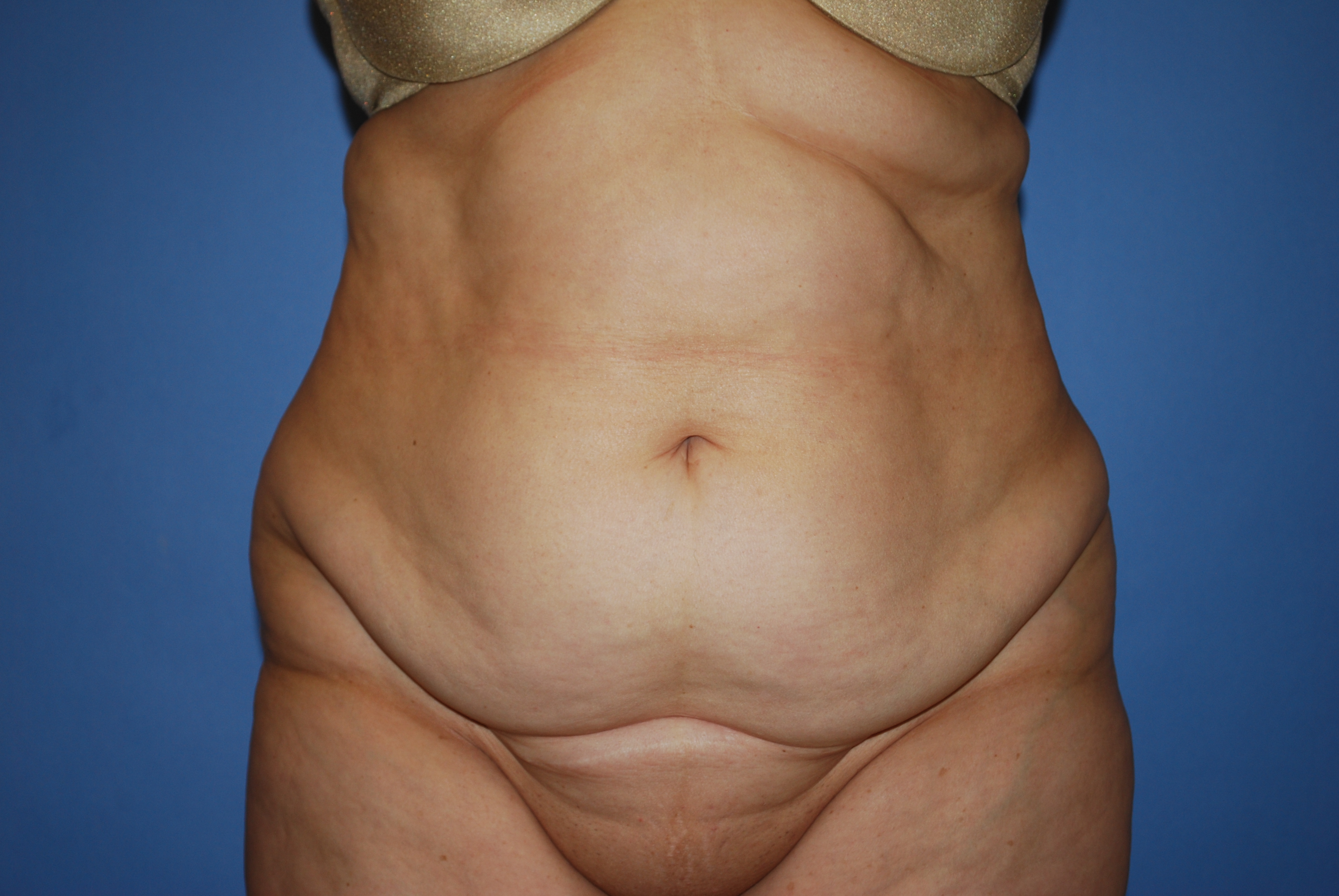 Abdominoplasty (Tummy Tuck) before and after - before