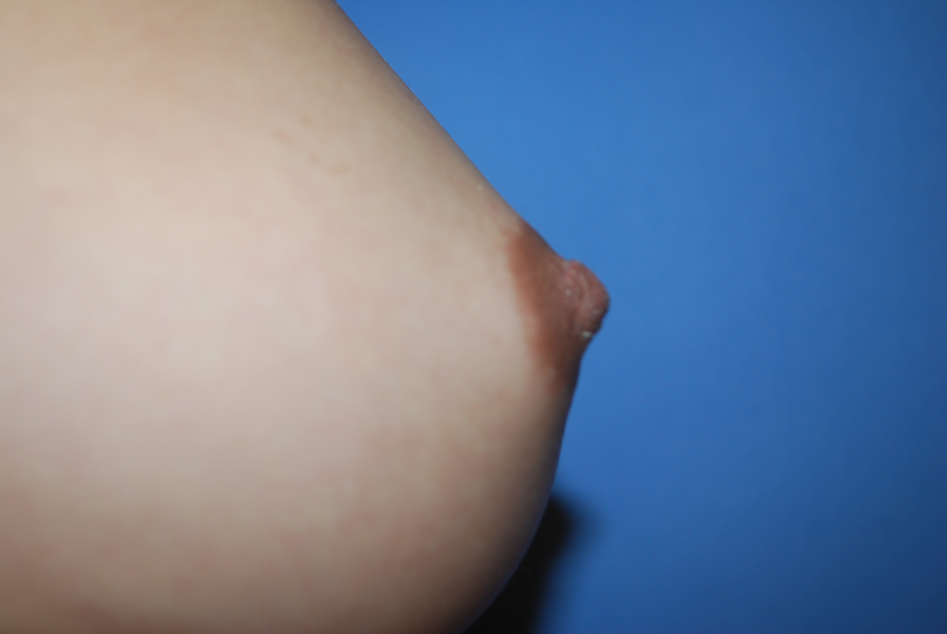 Nipple Reduction before and after - after
