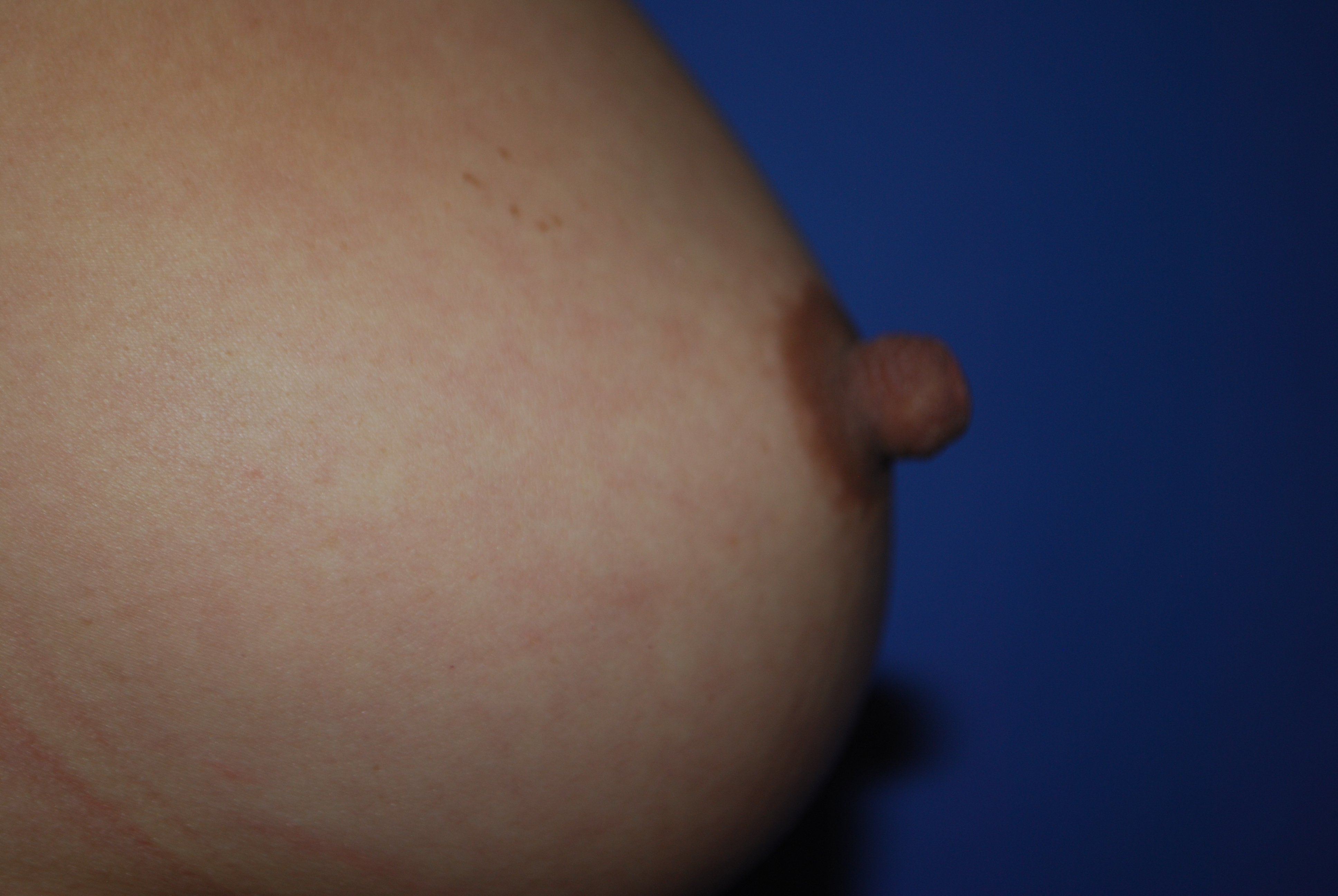 Nipple Reduction before and after - before