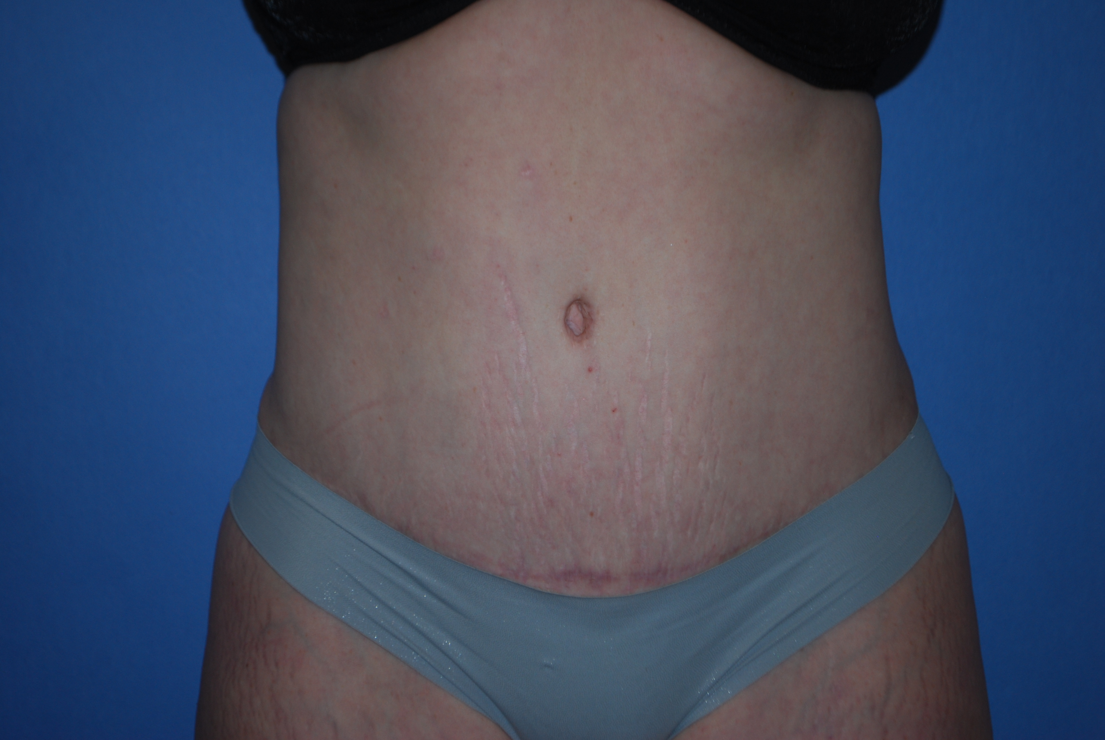 Abdominoplasty (Tummy Tuck) before and after - after