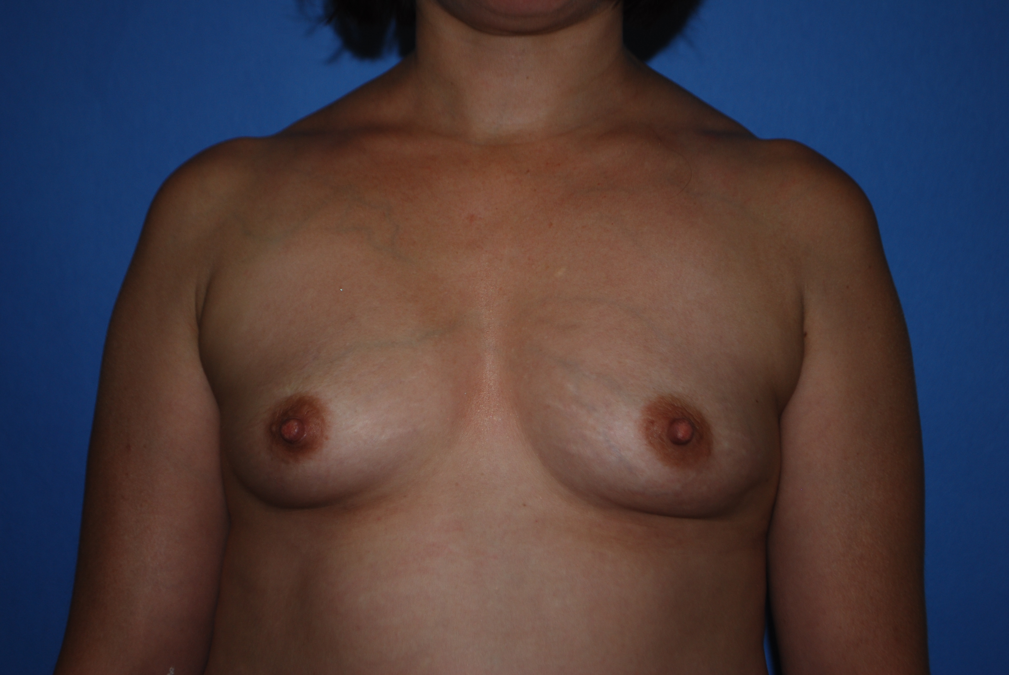 Breast Augmentation before and after - before