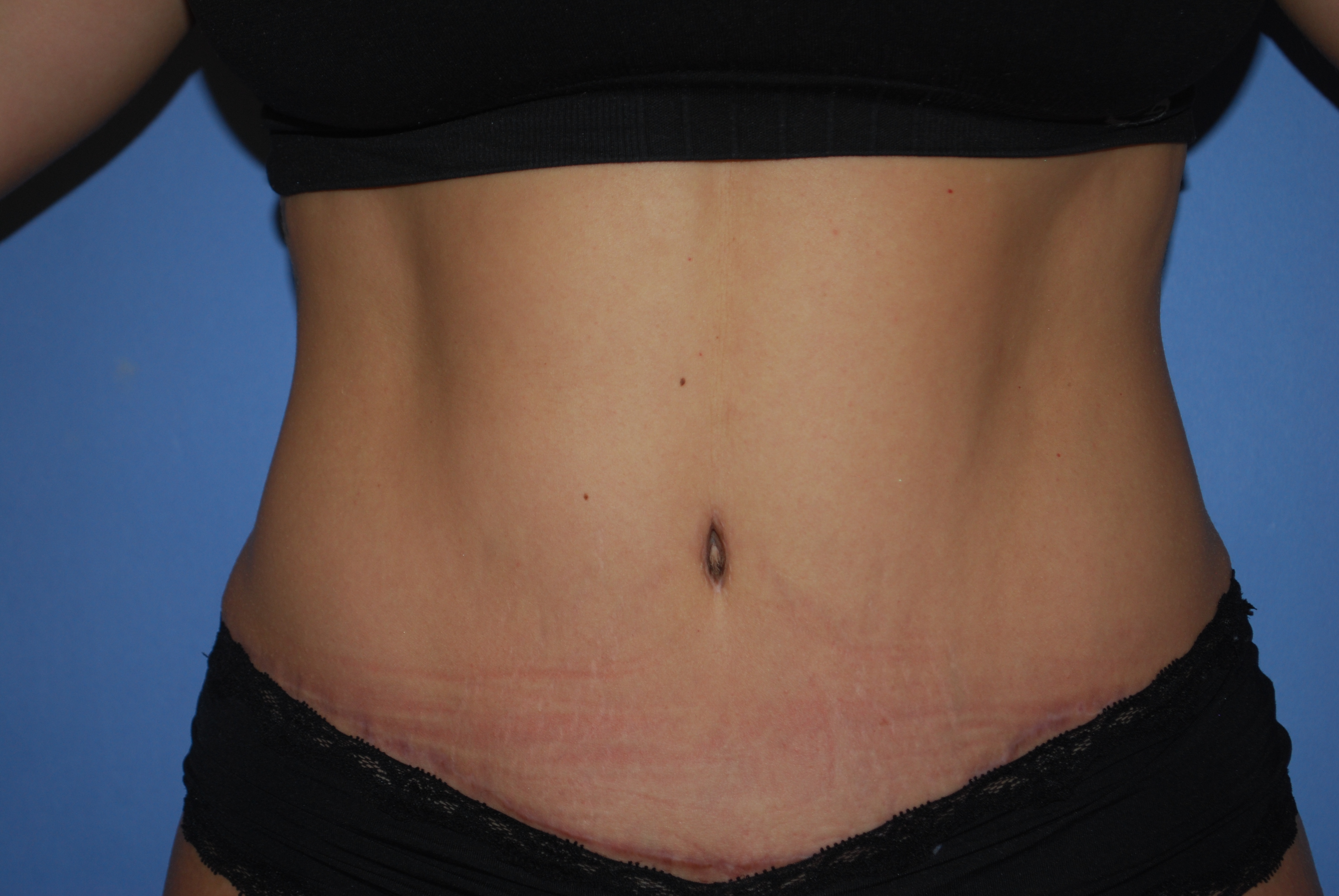 Abdominoplasty (Tummy Tuck) before and after - after