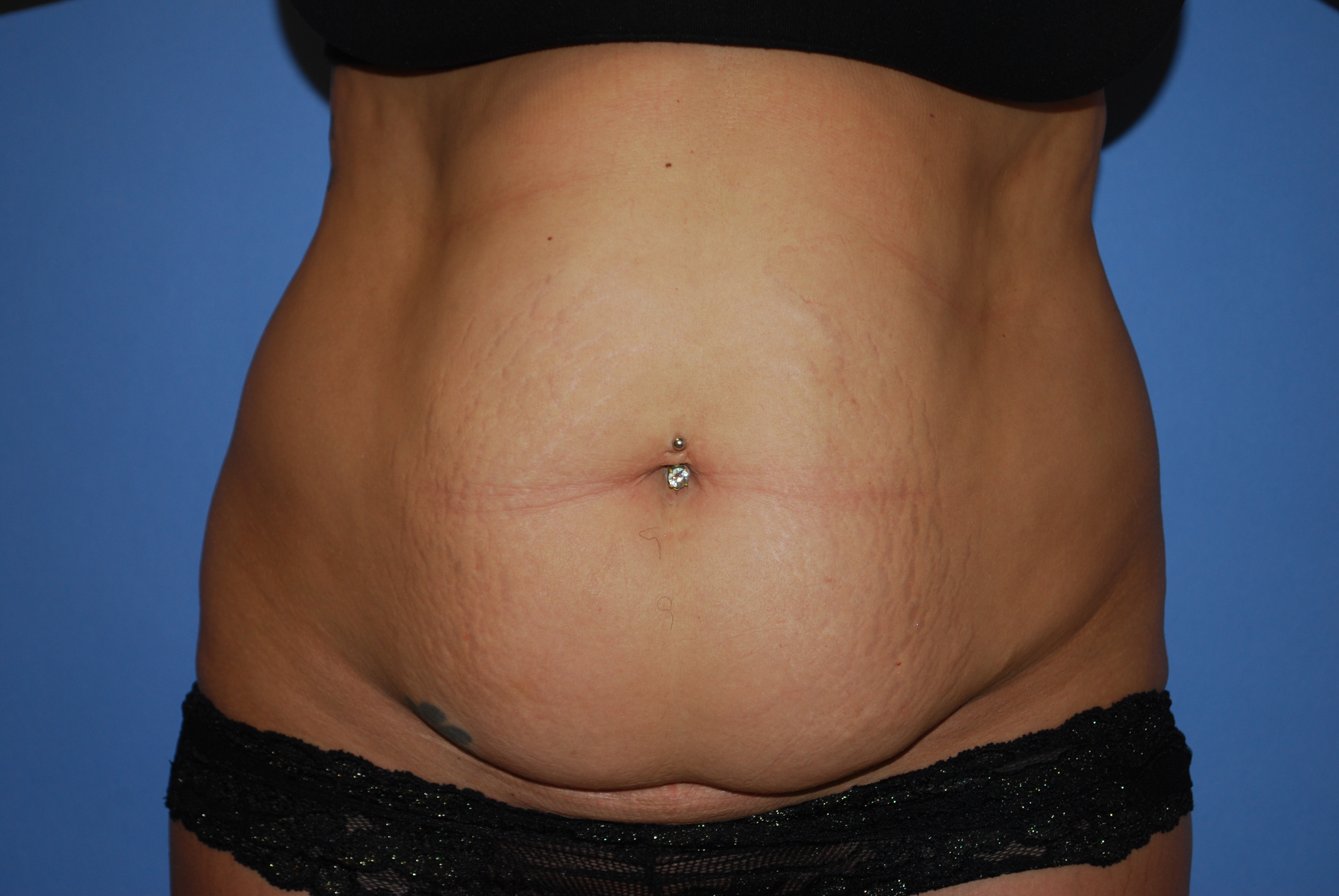 Abdominoplasty (Tummy Tuck) before and after - before
