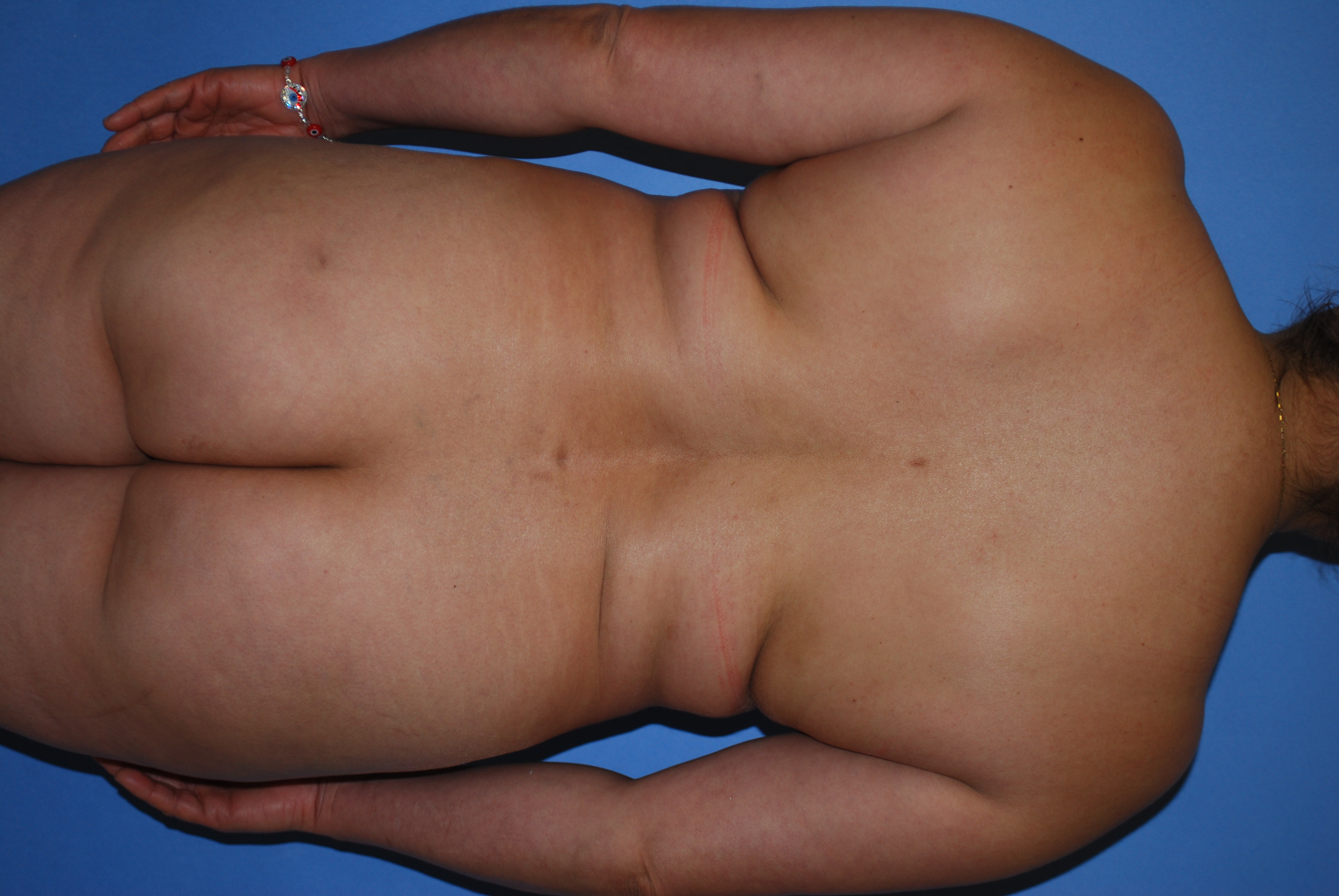 BBL (Fat Transfer) before and after - before
