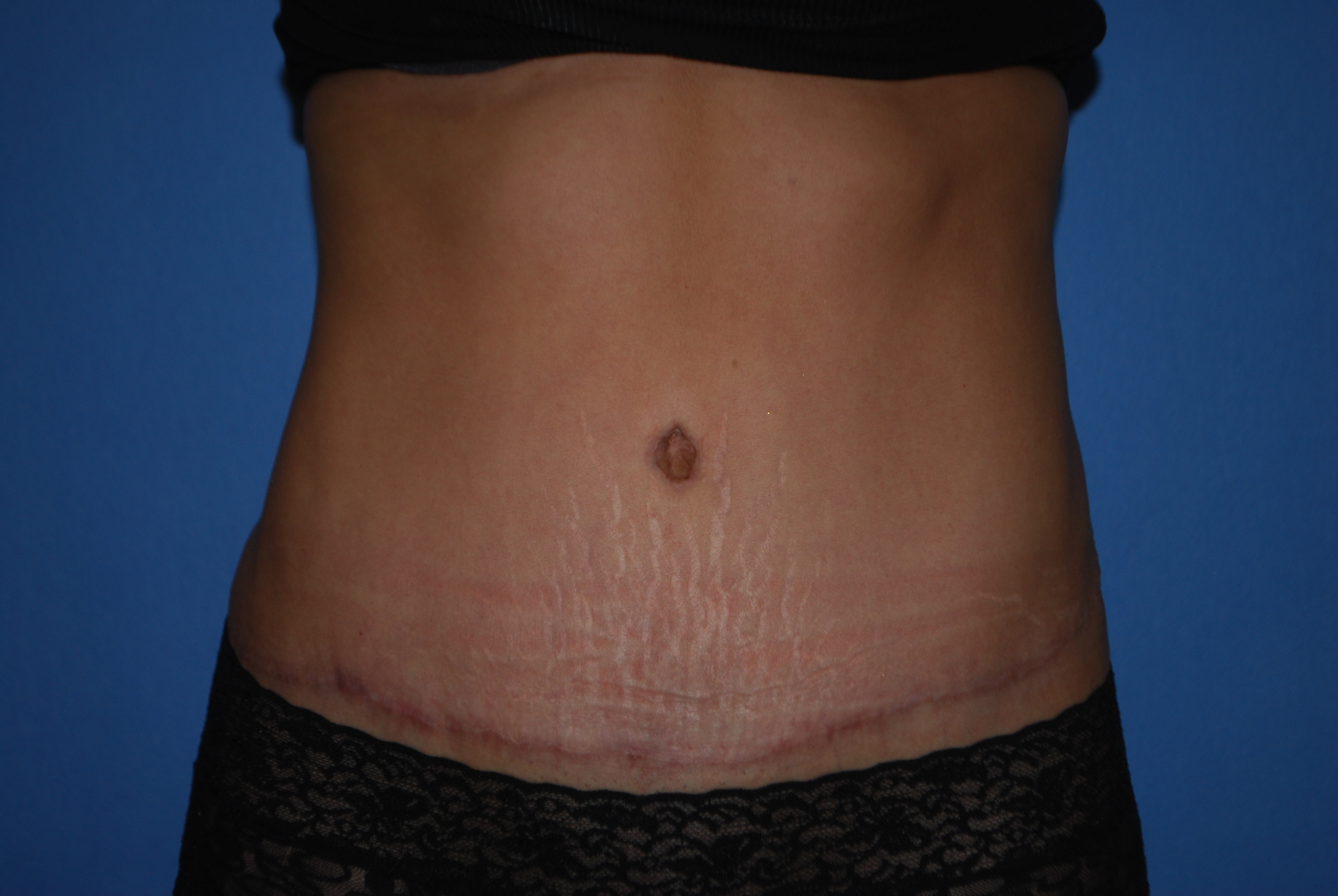 Abdominoplasty (Tummy Tuck) before and after - after