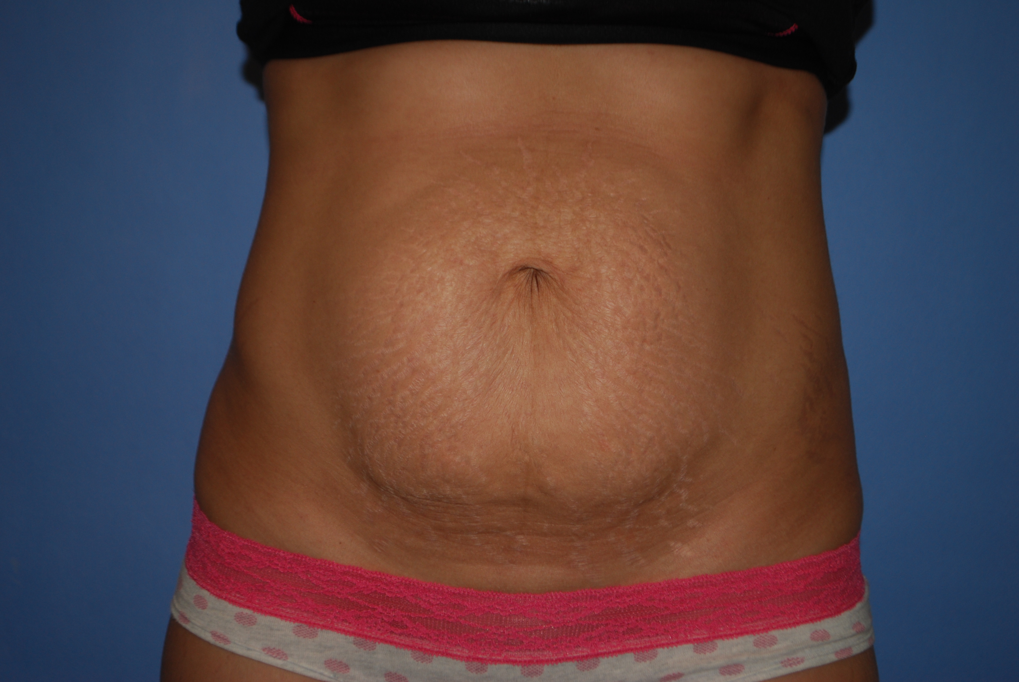 Abdominoplasty (Tummy Tuck) before and after - before