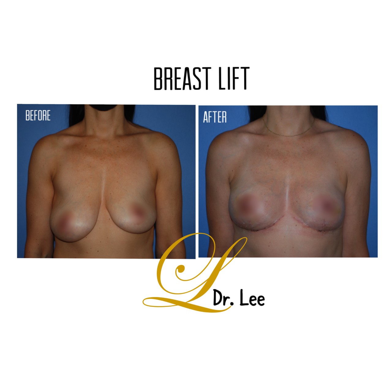 Breast Mastopexy (Lift) before and after - after