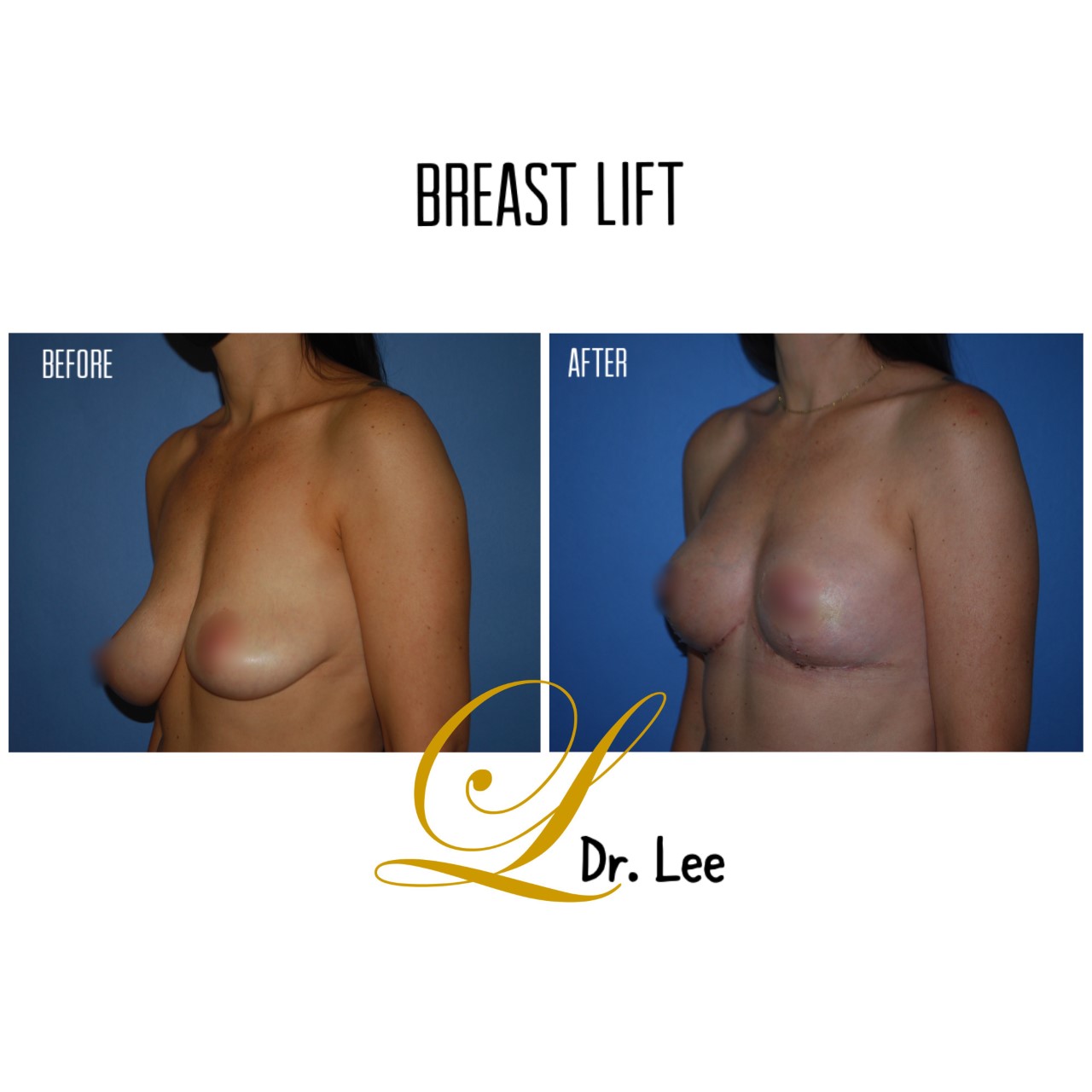 Breast Mastopexy (Lift) before and after - before