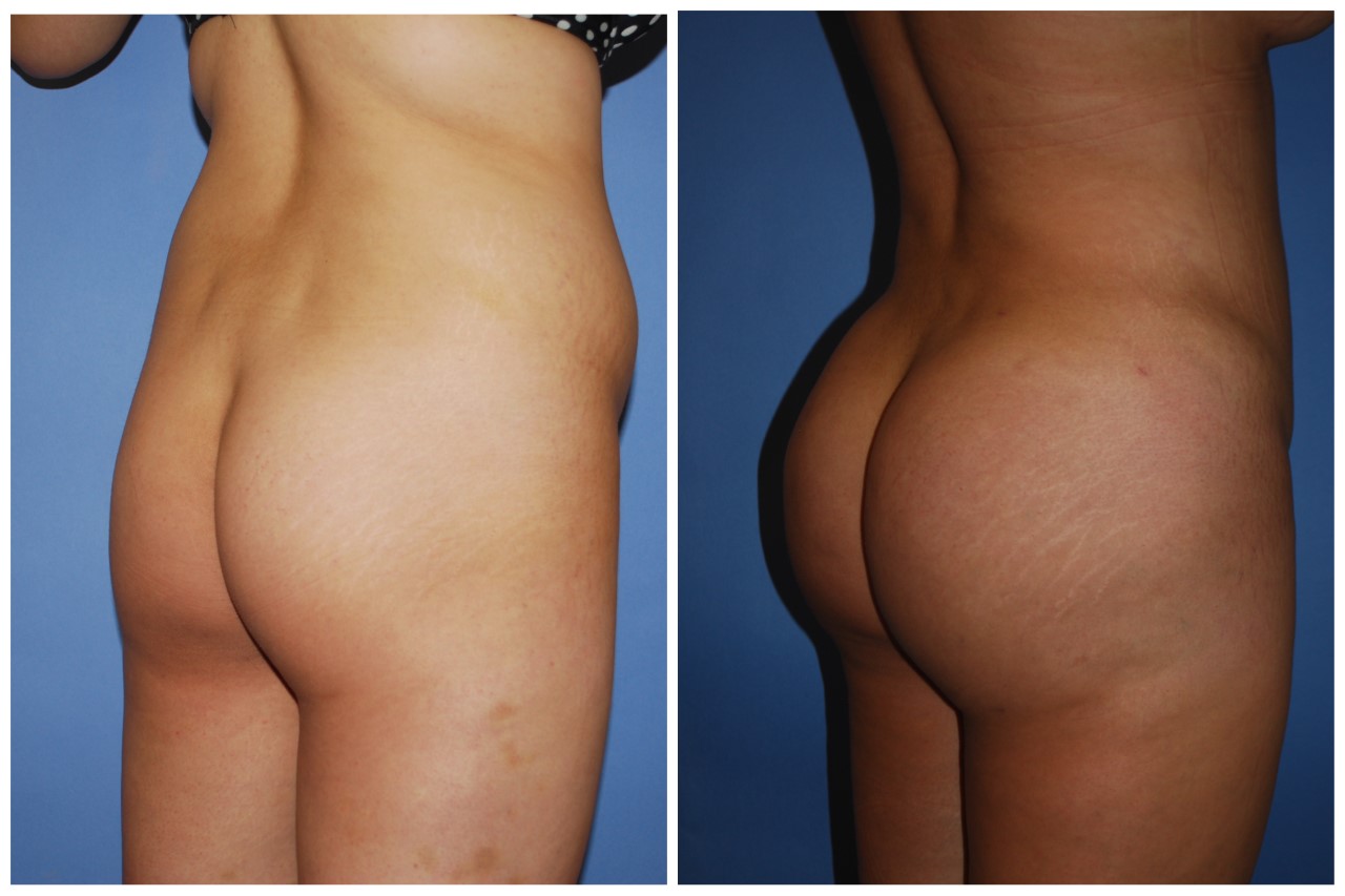 BBL (Fat Transfer) before and after - after