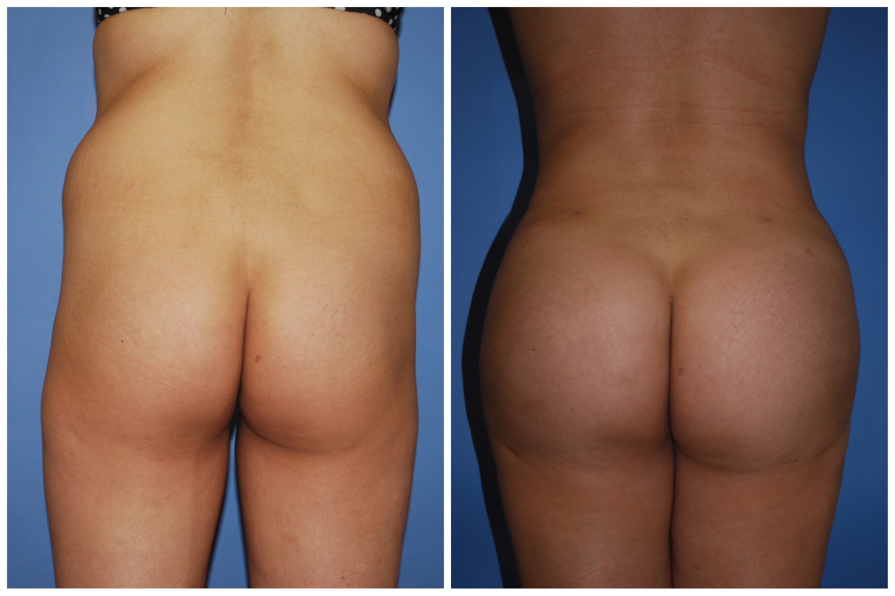 BBL (Fat Transfer) before and after - before