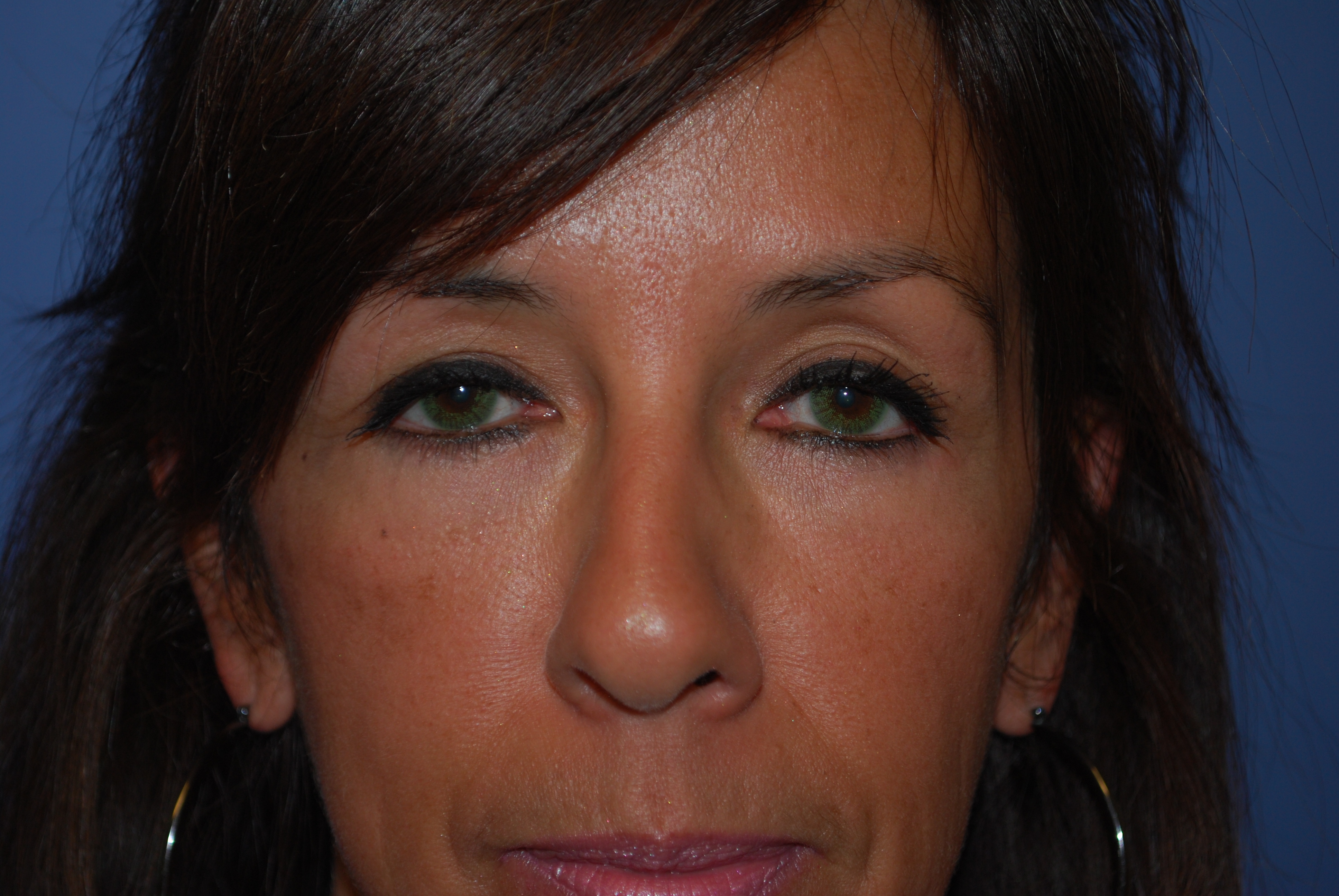 Brow Lift before and after - after