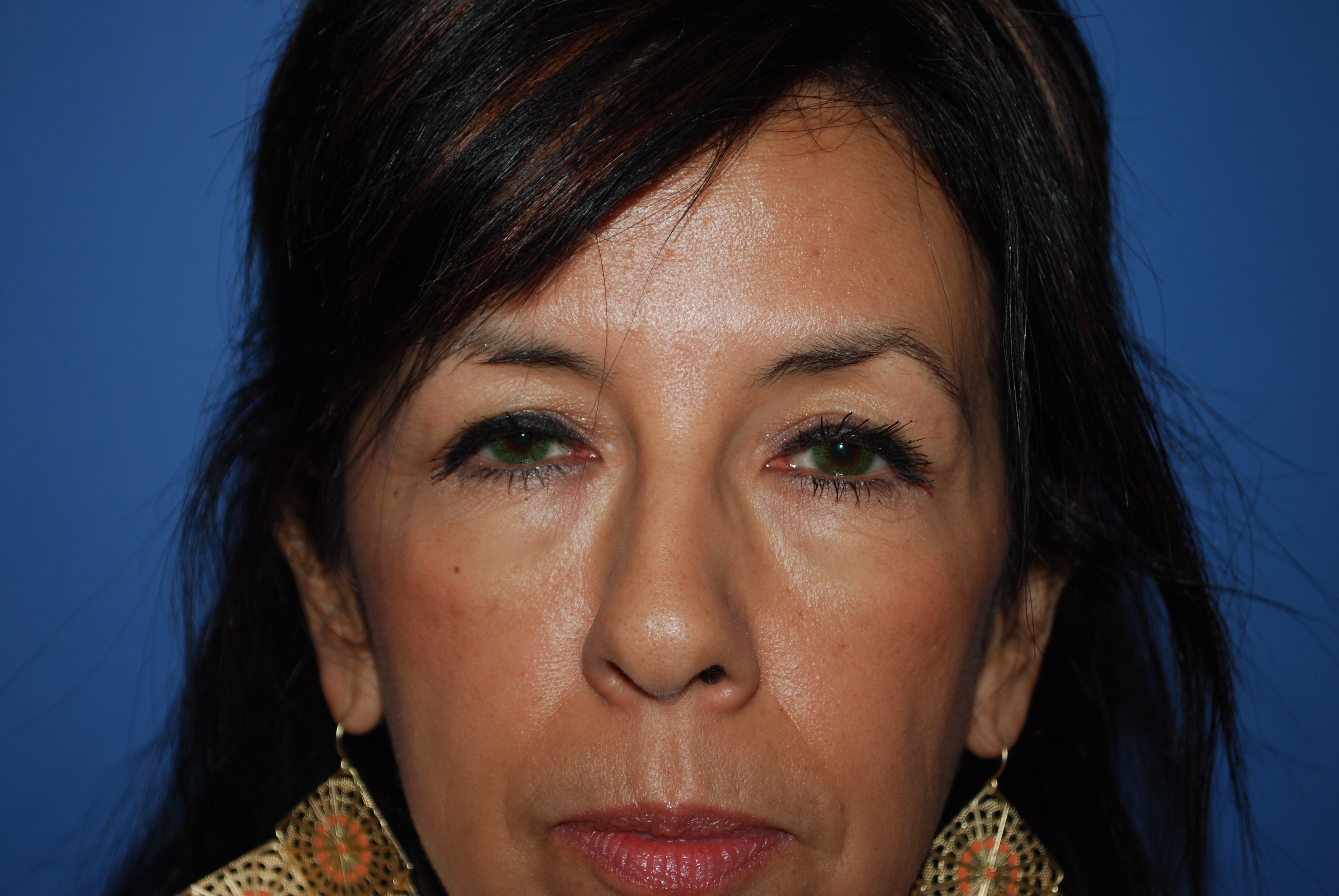 Brow Lift before and after - before