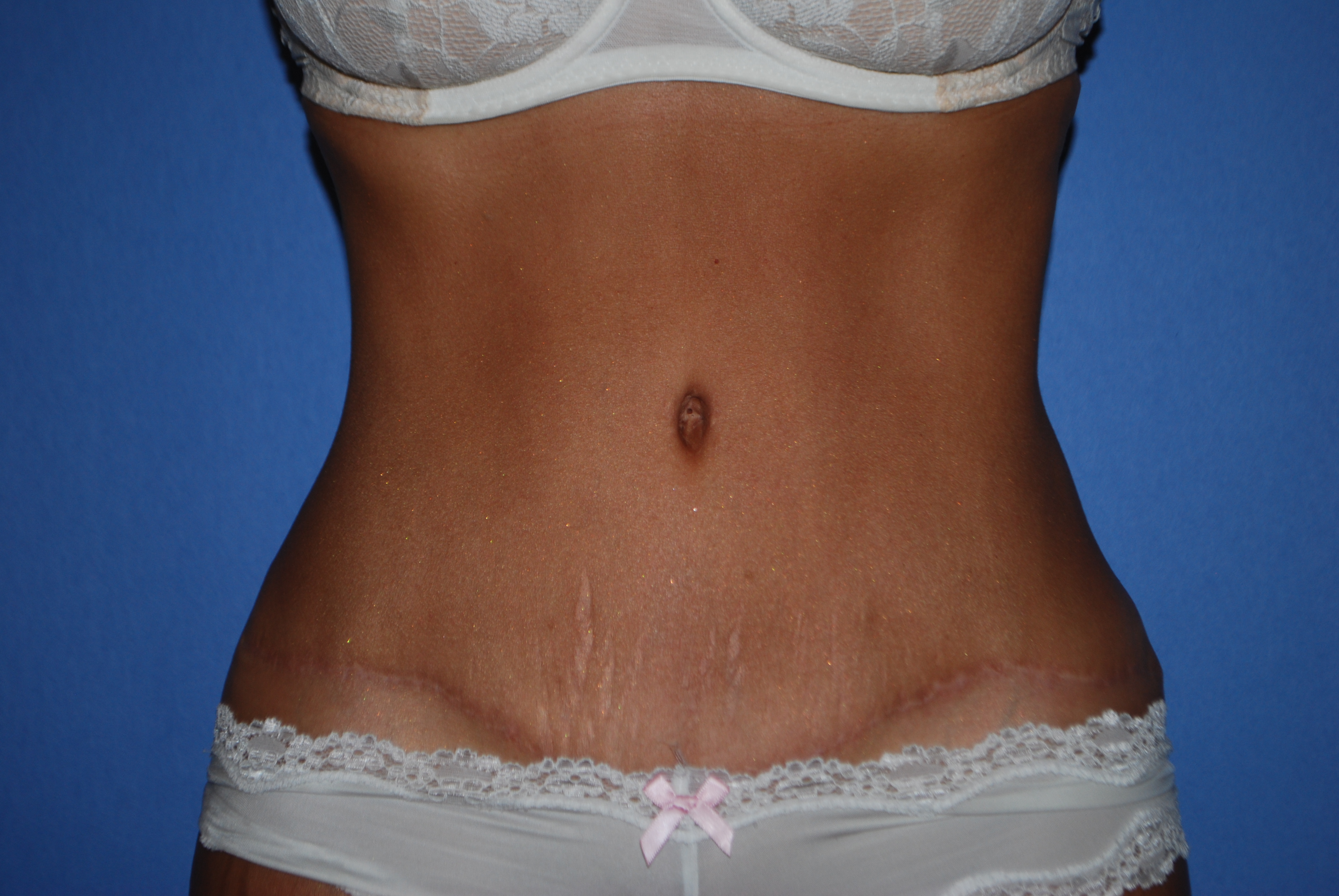 Abdominoplasty (Tummy Tuck) before and after - after