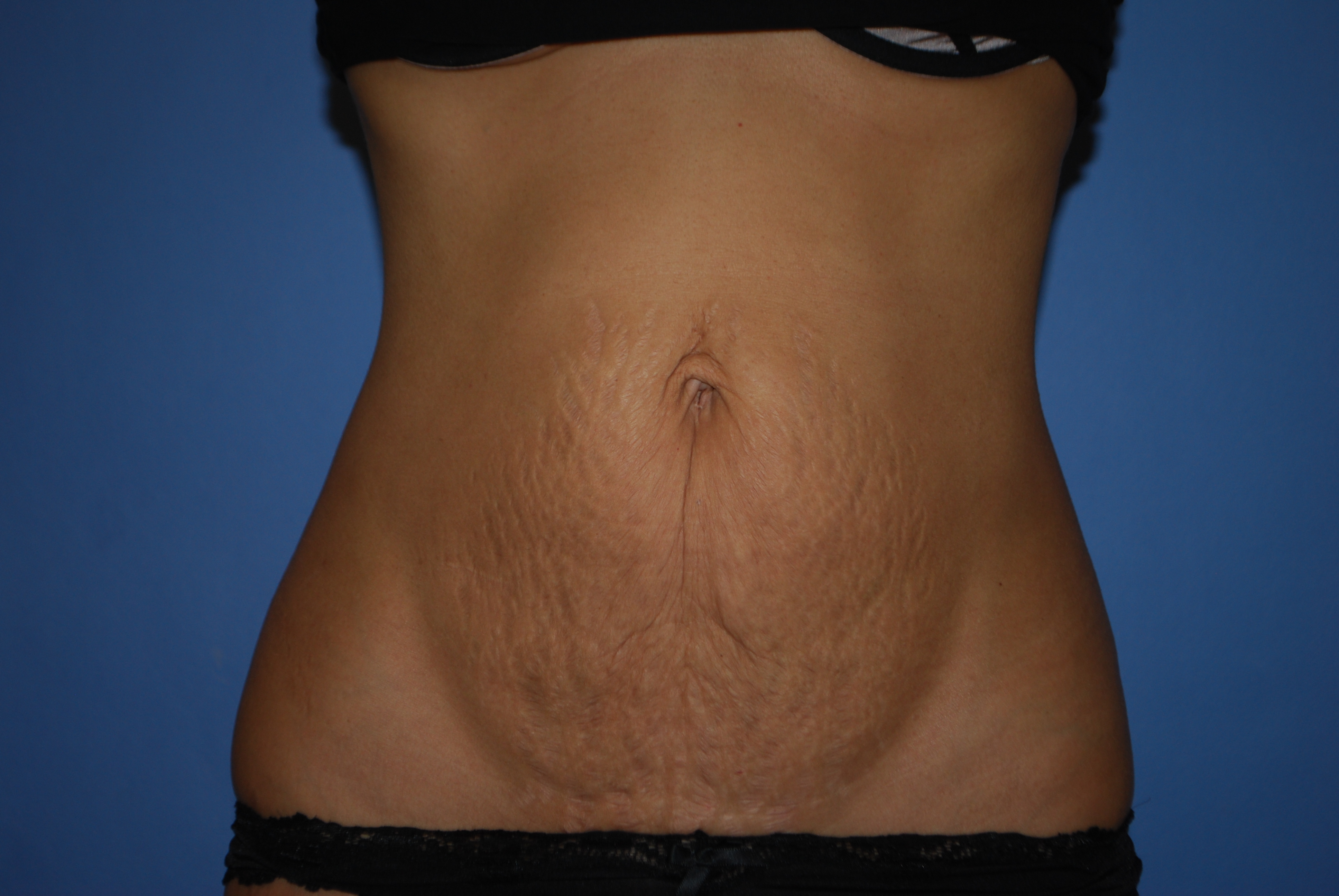 Abdominoplasty (Tummy Tuck) before and after - before