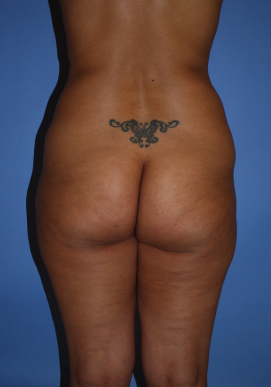 BBL (Fat Transfer) before and after - before