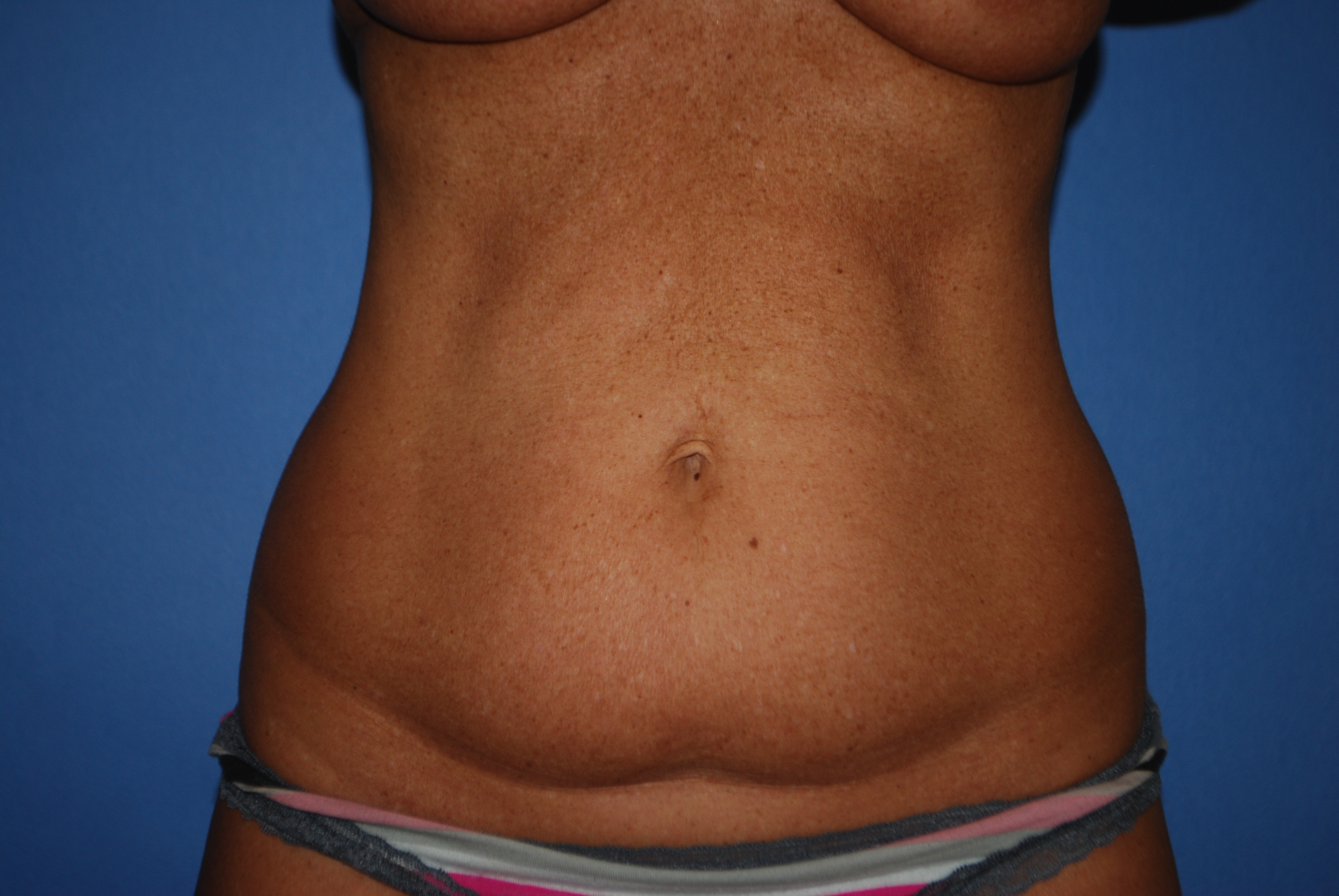 Abdominoplasty (Tummy Tuck) before and after - before