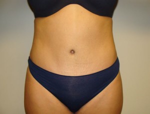 Diastasis Recti before and after - after