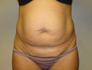 Diastasis Recti before and after - before