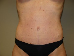 Diastasis Recti before and after - after