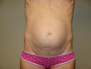 Diastasis Recti before and after - before