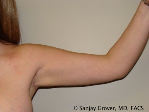 Arm Lift after — Dr. Sanjay Grover