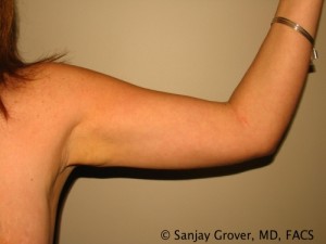 Arm Lift before — Dr. Sanjay Grover