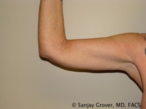Arm Lift after — Dr. Sanjay Grover