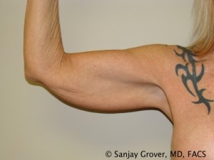 Arm Lift before — Dr. Sanjay Grover